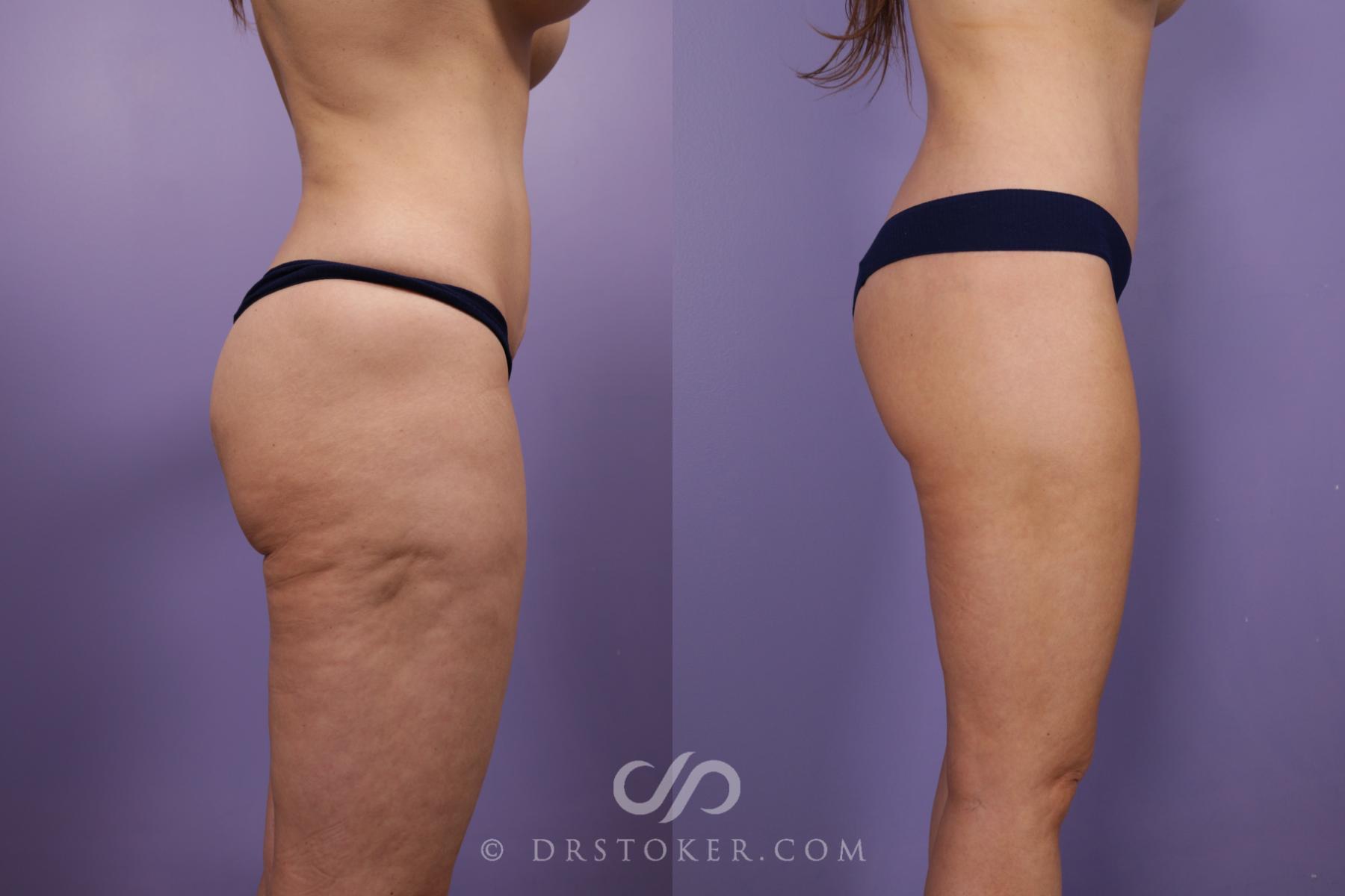 Before & After Bikini Body Lift ™ Case 2425 Right Side View in Los Angeles, CA