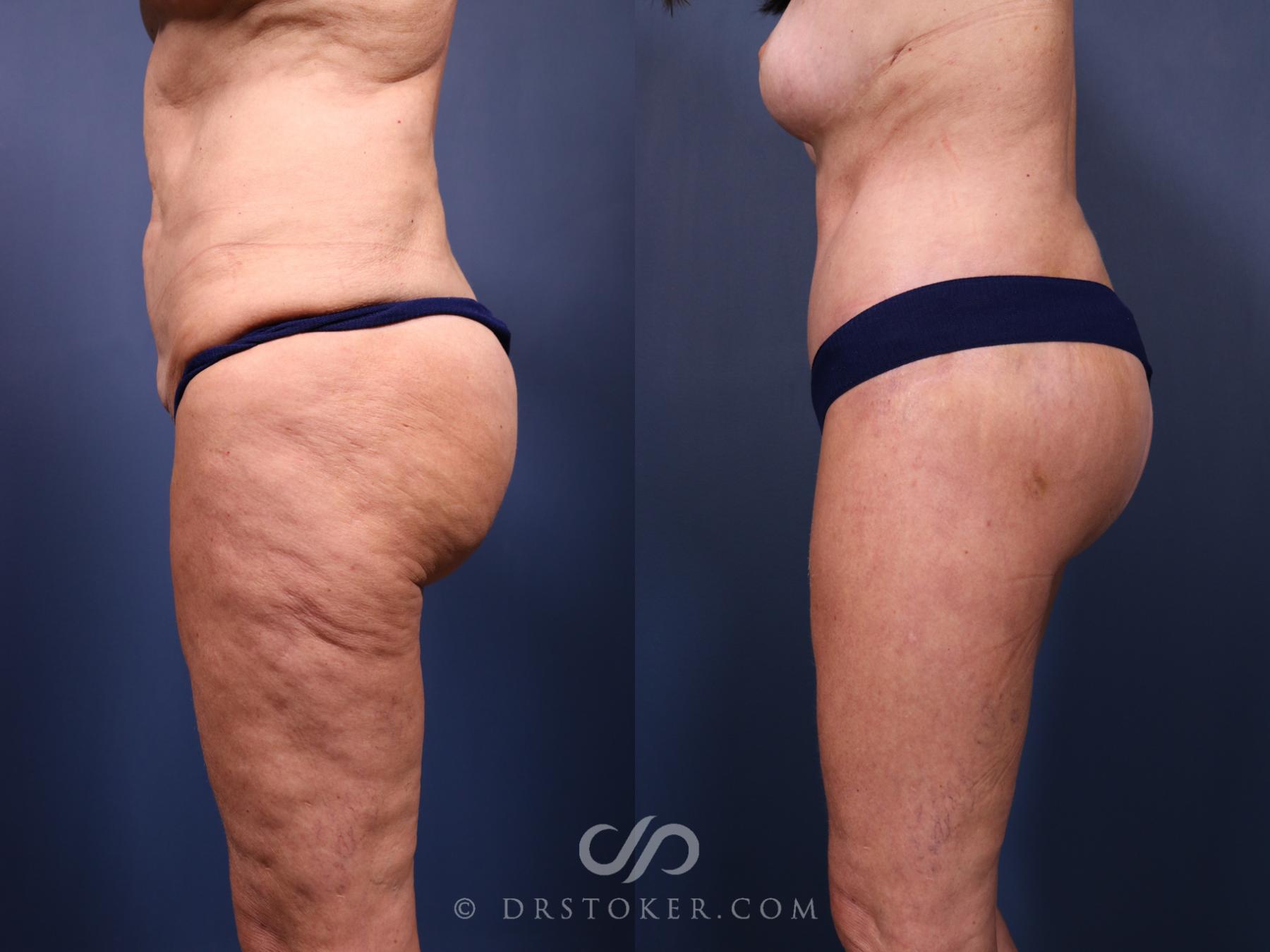 Before & After Bikini Body Lift ™ Case 2426 Left Side View in Los Angeles, CA