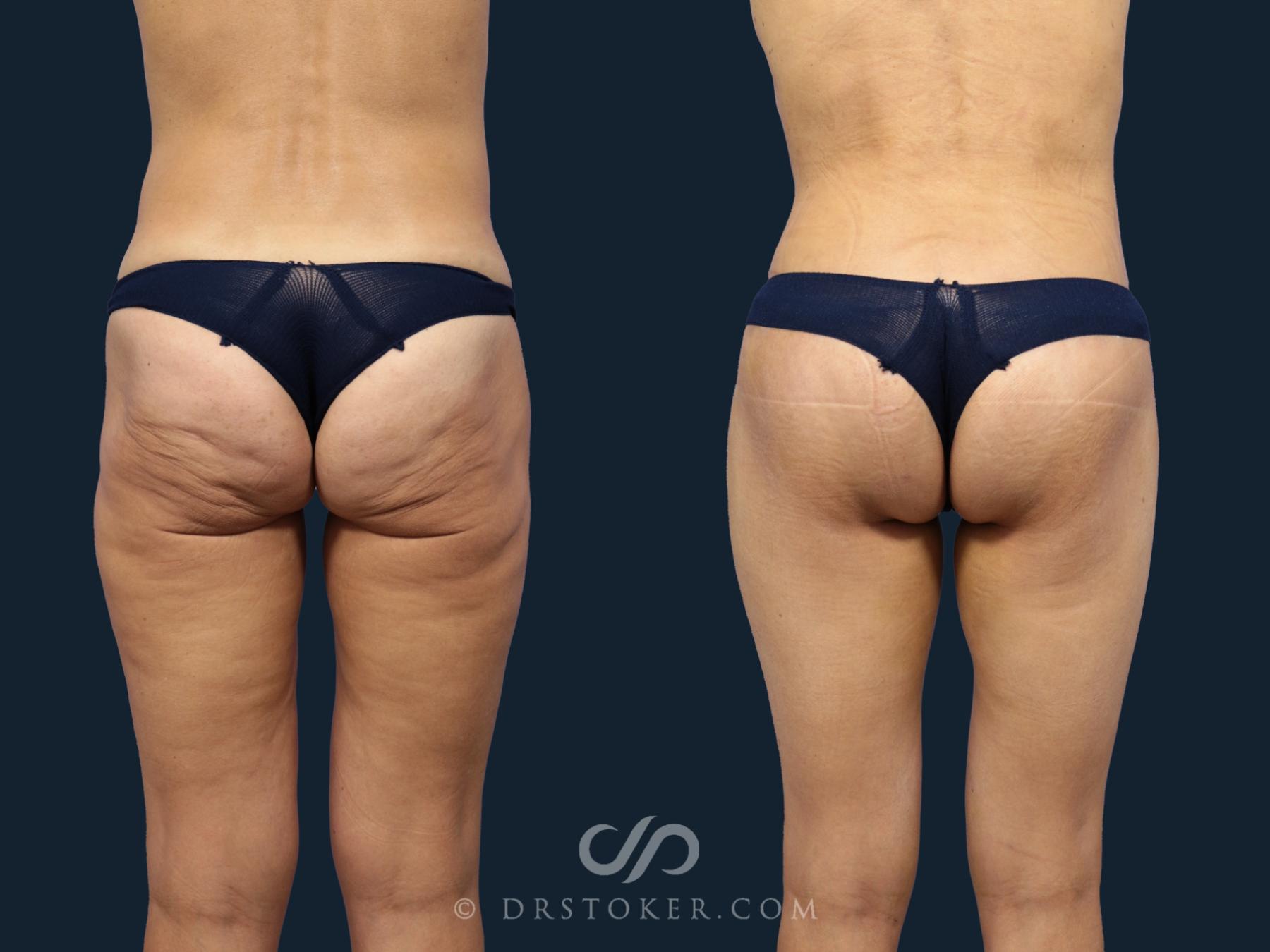 Before & After Bikini Body Lift ™ Case 2427 Back View in Los Angeles, CA