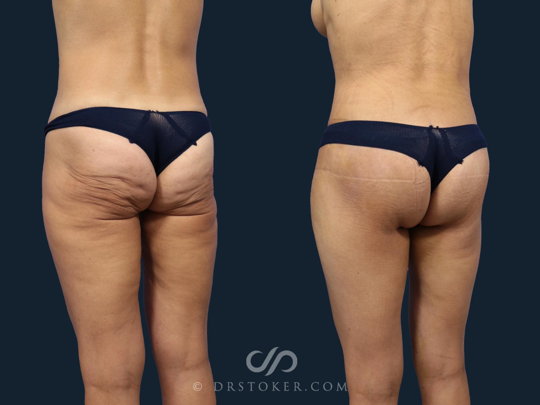 Before & After Bikini Body Lift ™ Case 2427 Left Oblique View in Los Angeles, CA