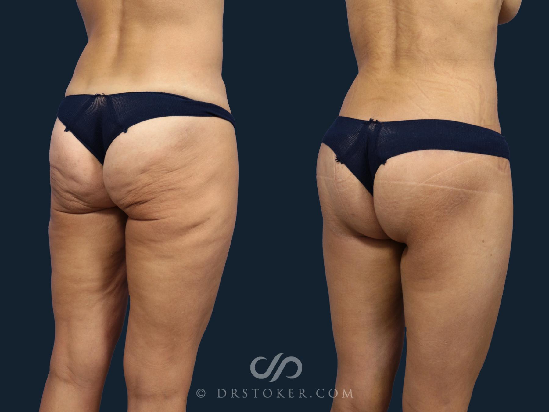 Before & After Bikini Body Lift ™ Case 2427 Right Oblique View in Los Angeles, CA