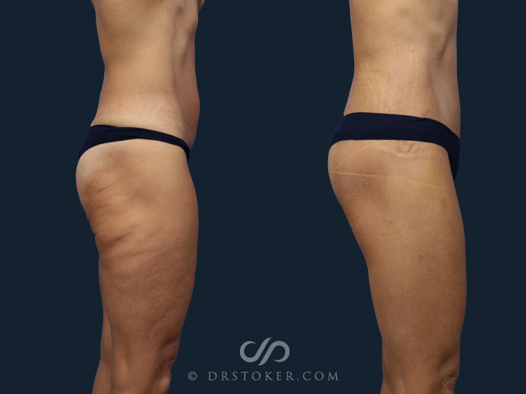 Before & After Bikini Body Lift ™ Case 2427 Right Side View in Los Angeles, CA