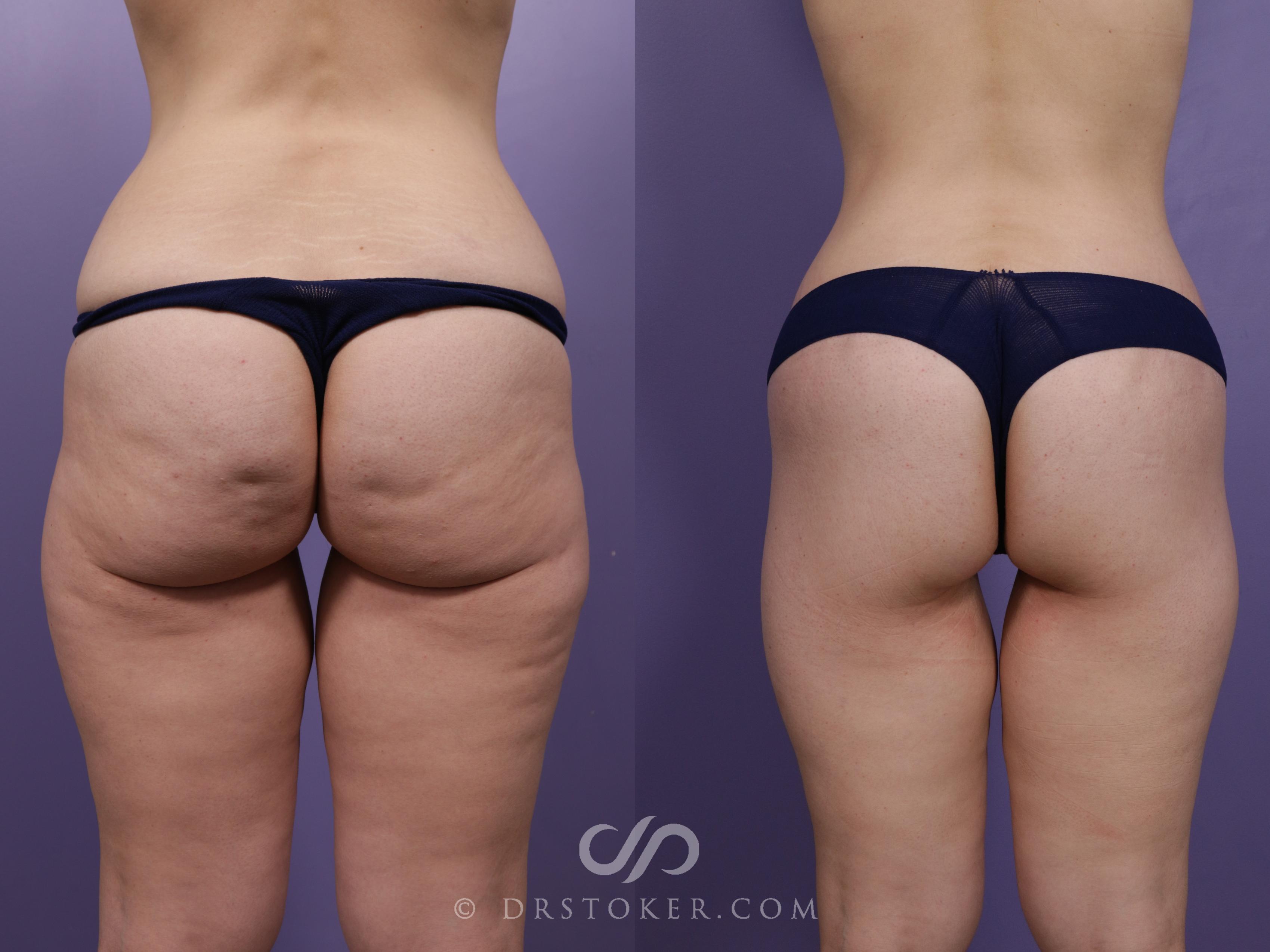 Before & After Bikini Body Lift ™ Case 2428 Back View in Los Angeles, CA