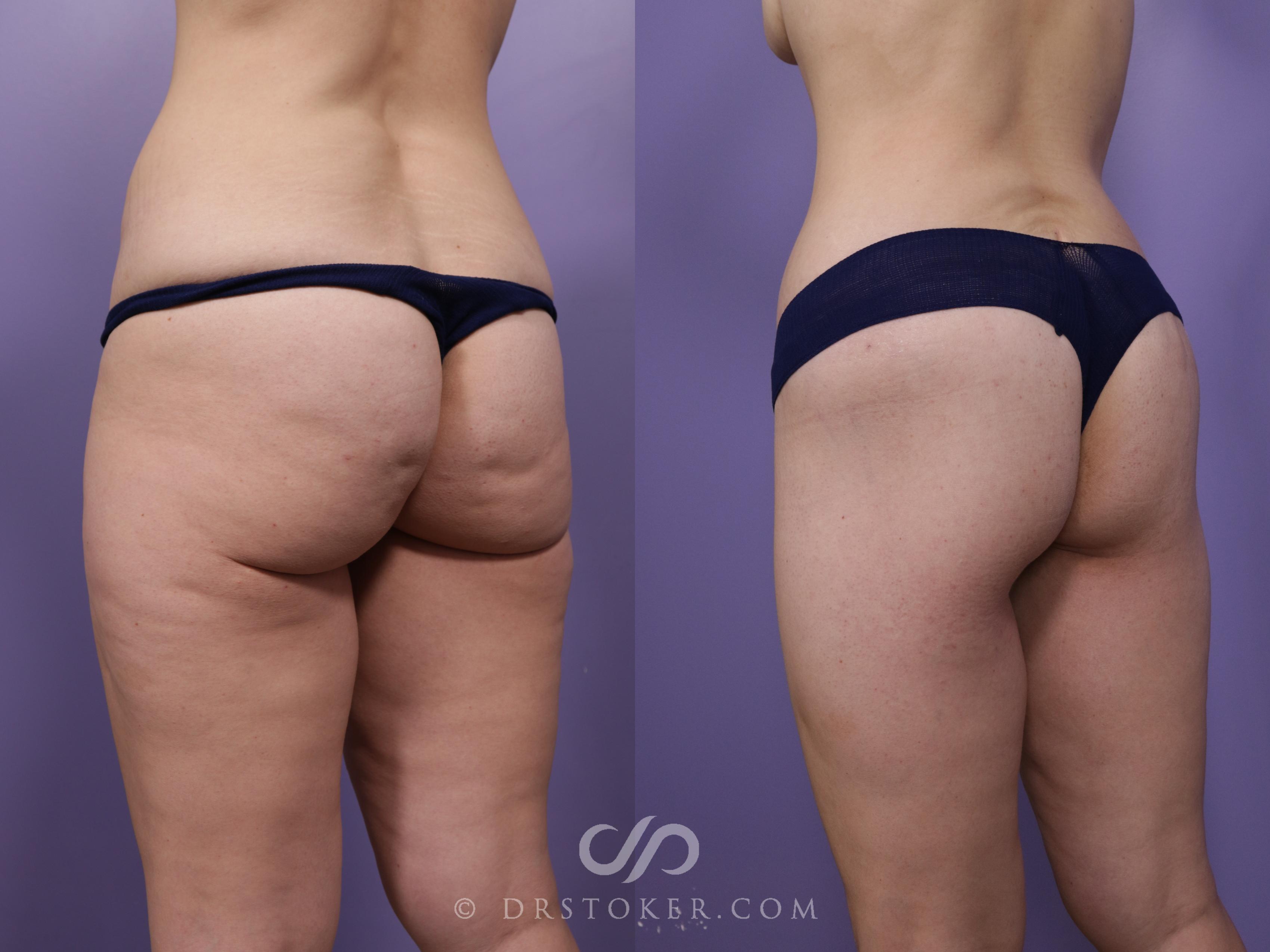 Before & After Bikini Body Lift ™ Case 2428 Left Oblique View in Los Angeles, CA