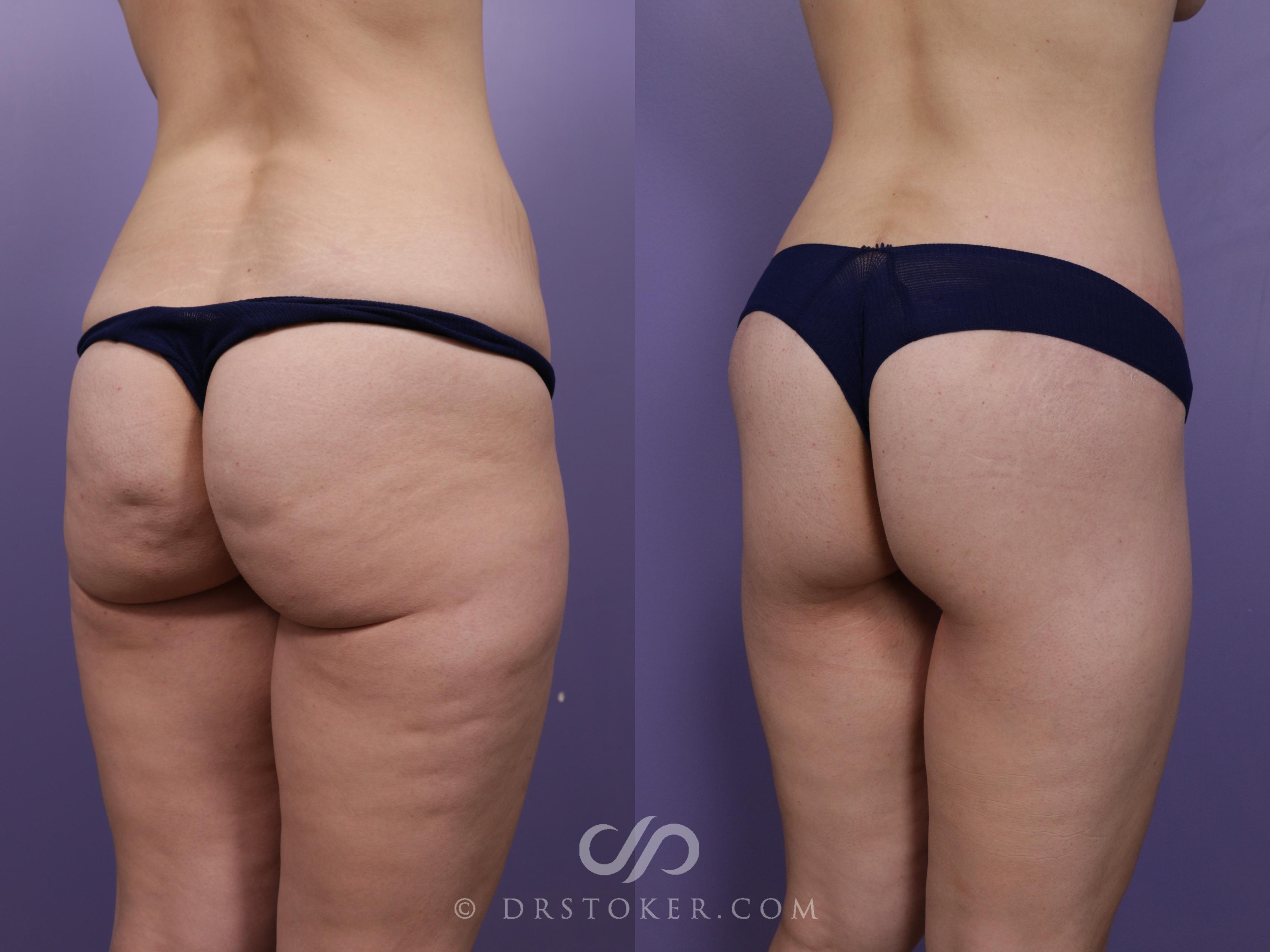 Before & After Bikini Body Lift ™ Case 2428 Right Oblique View in Los Angeles, CA
