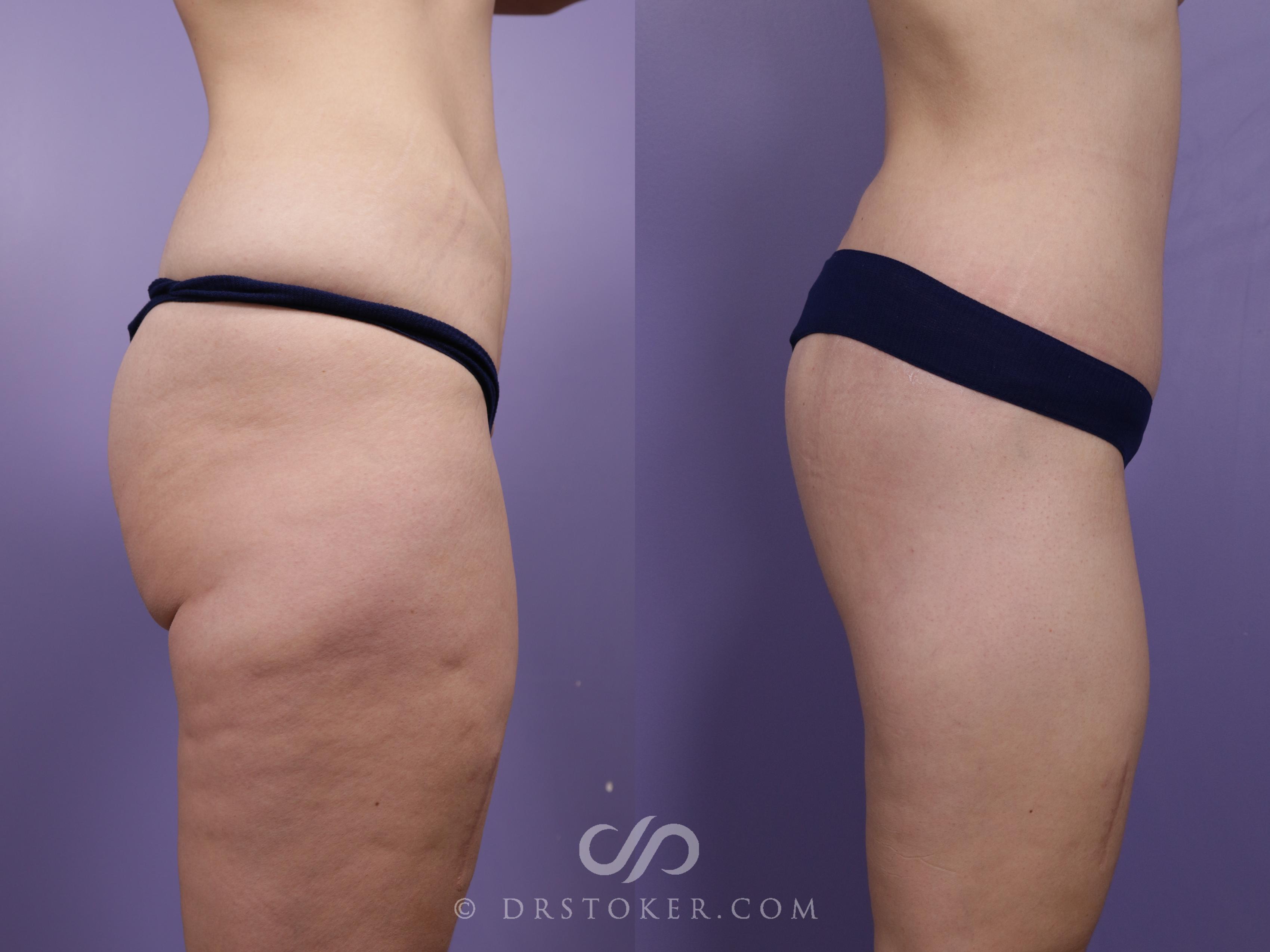 Before & After Bikini Body Lift ™ Case 2428 Right Side View in Los Angeles, CA