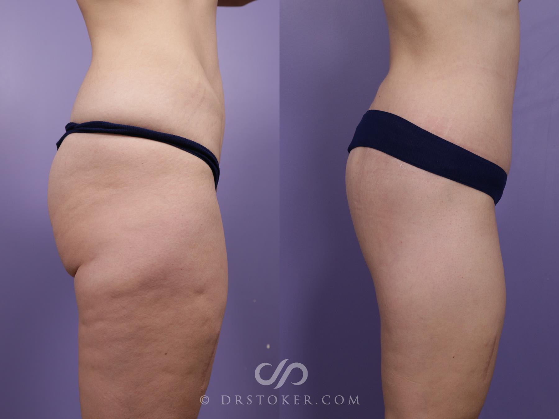 Before & After Bikini Body Lift ™ Case 2428 Right Side View in Los Angeles, CA