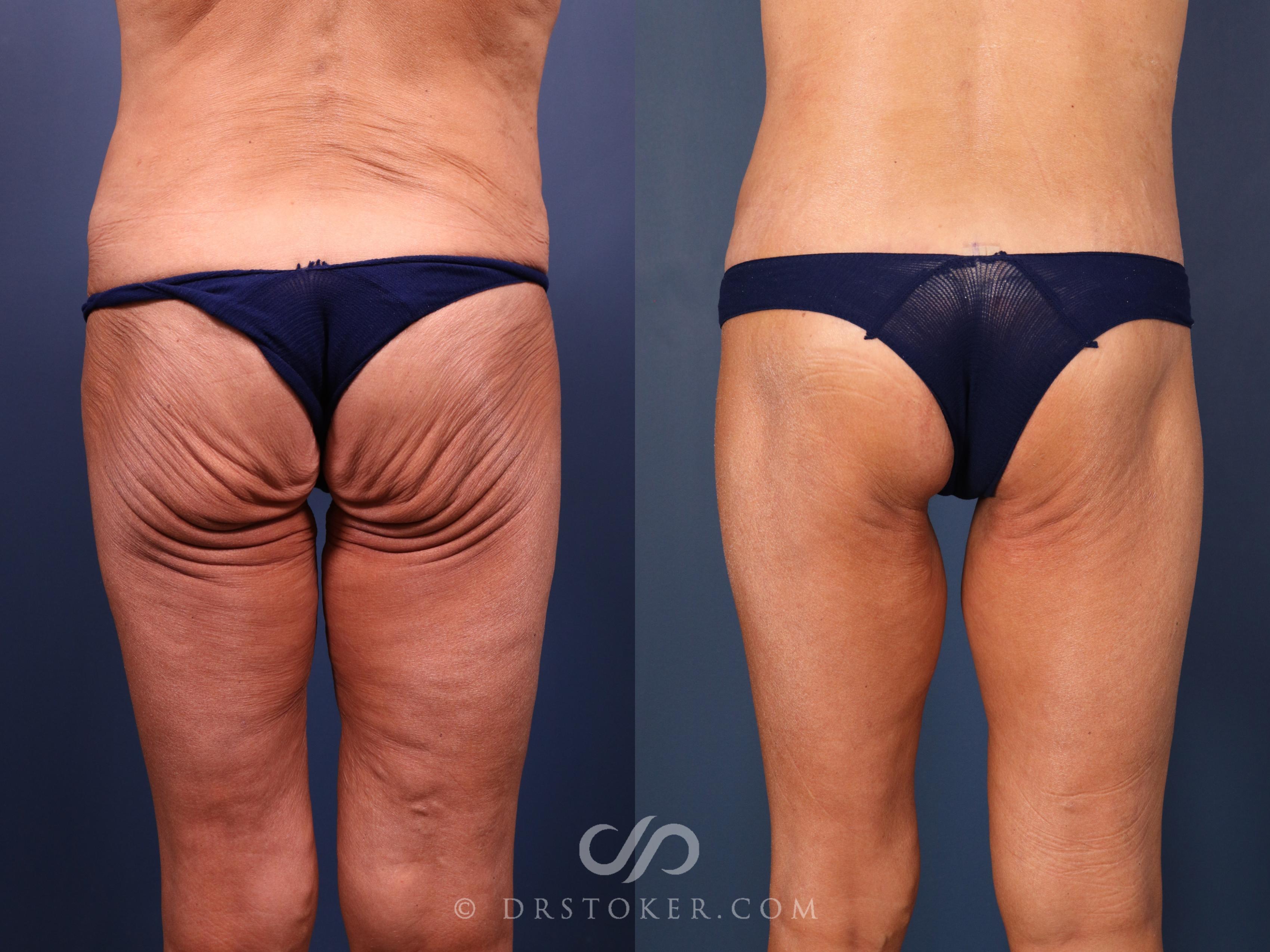 Before & After Bikini Body Lift ™ Case 2429 Back View in Los Angeles, CA