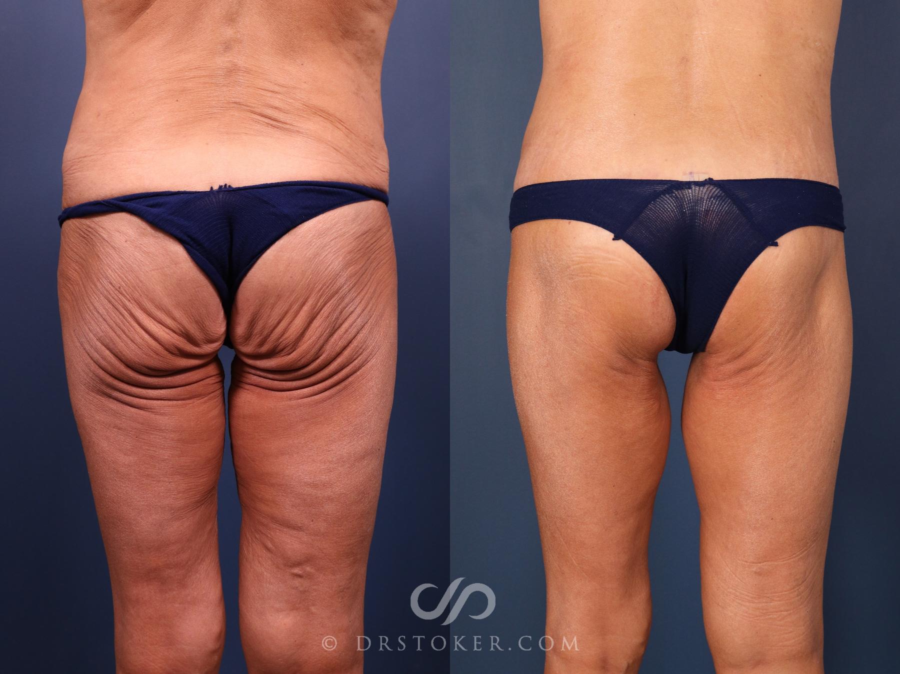 Before & After Bikini Body Lift ™ Case 2429 Back View in Los Angeles, CA