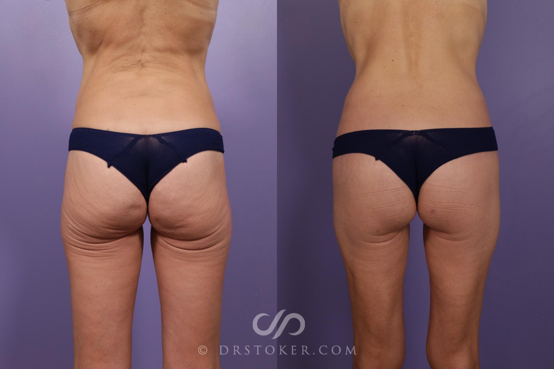 Before & After Bikini Body Lift ™ Case 2430 Back View in Los Angeles, CA