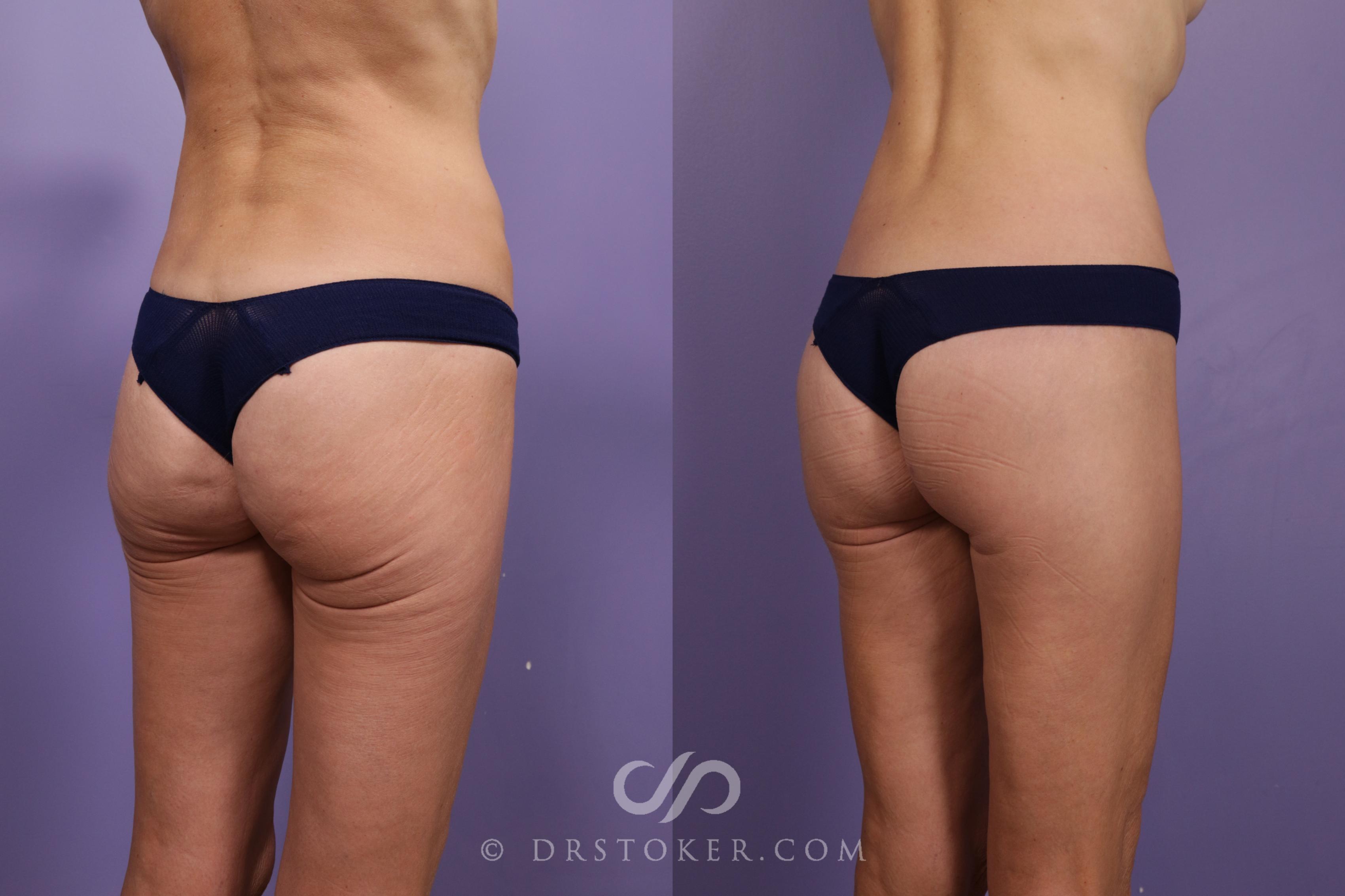 Before & After Bikini Body Lift ™ Case 2430 Right Oblique View in Los Angeles, CA