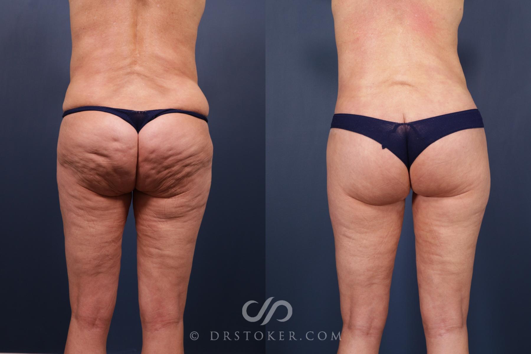 Before & After Bikini Body Lift ™ Case 2431 Back View in Los Angeles, CA