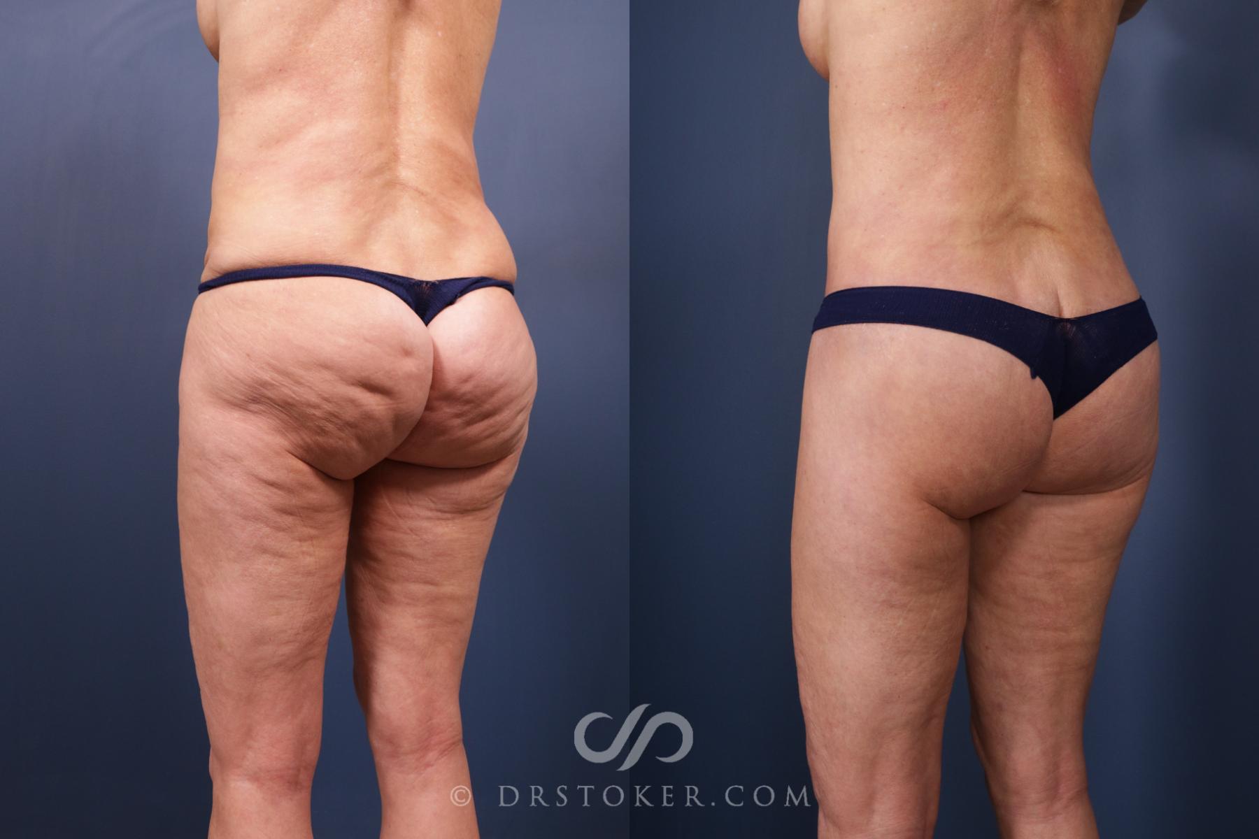 Before & After Bikini Body Lift ™ Case 2431 Left Oblique View in Los Angeles, CA