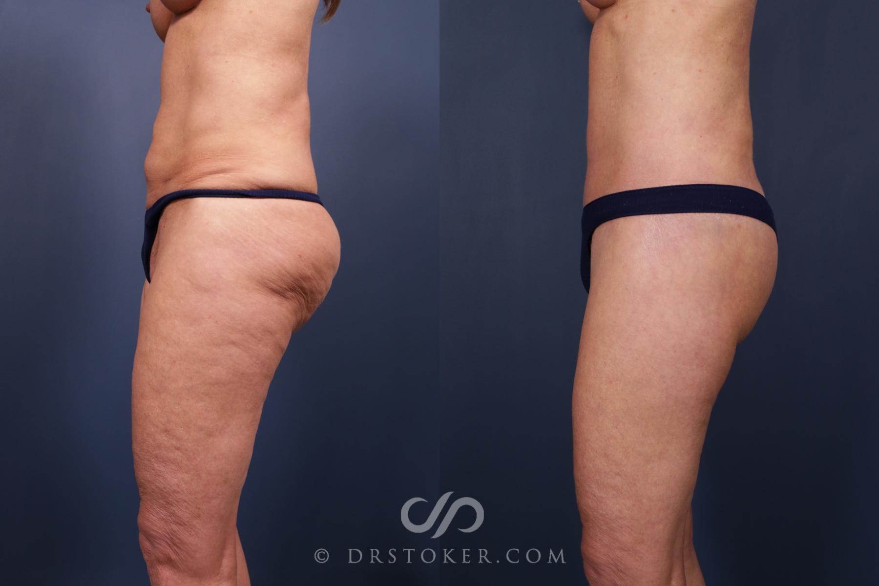 Before & After Bikini Body Lift ™ Case 2431 Left Side View in Los Angeles, CA