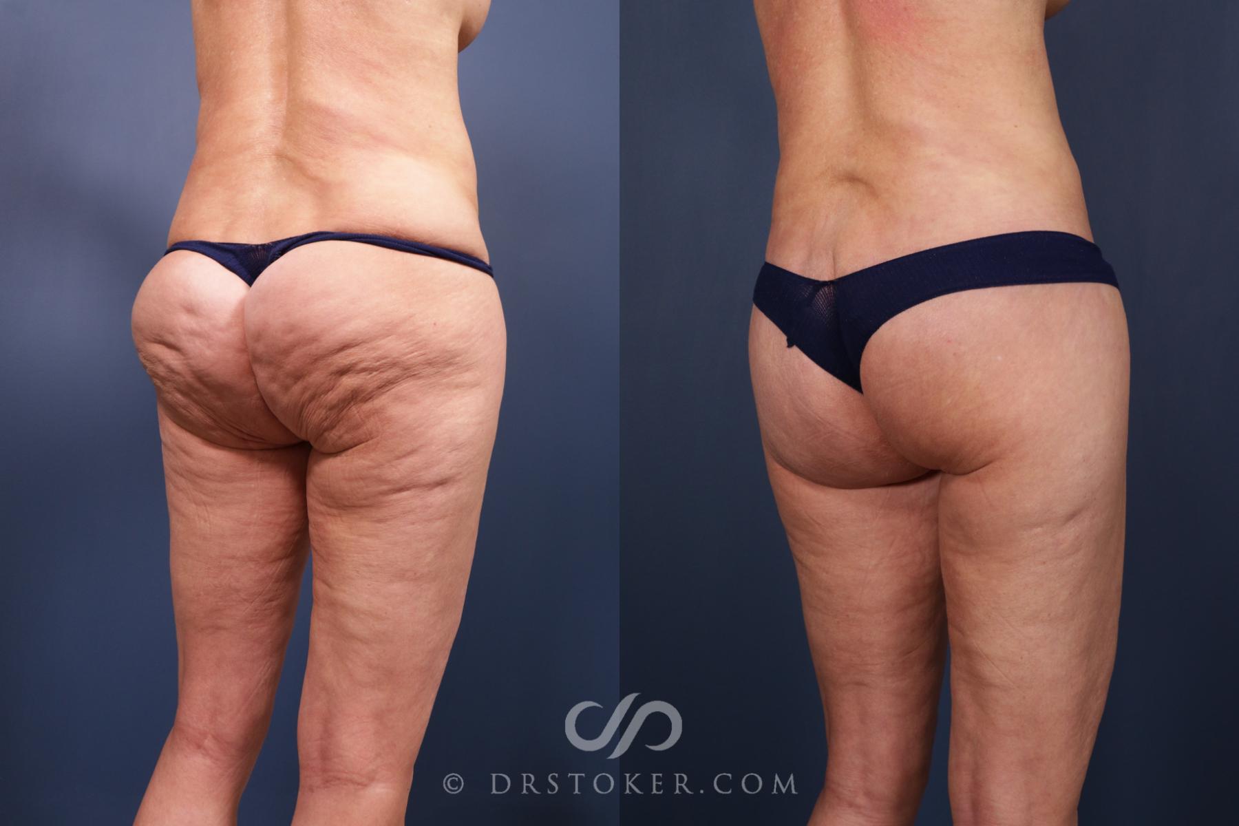 Before & After Bikini Body Lift ™ Case 2431 Right Oblique View in Los Angeles, CA