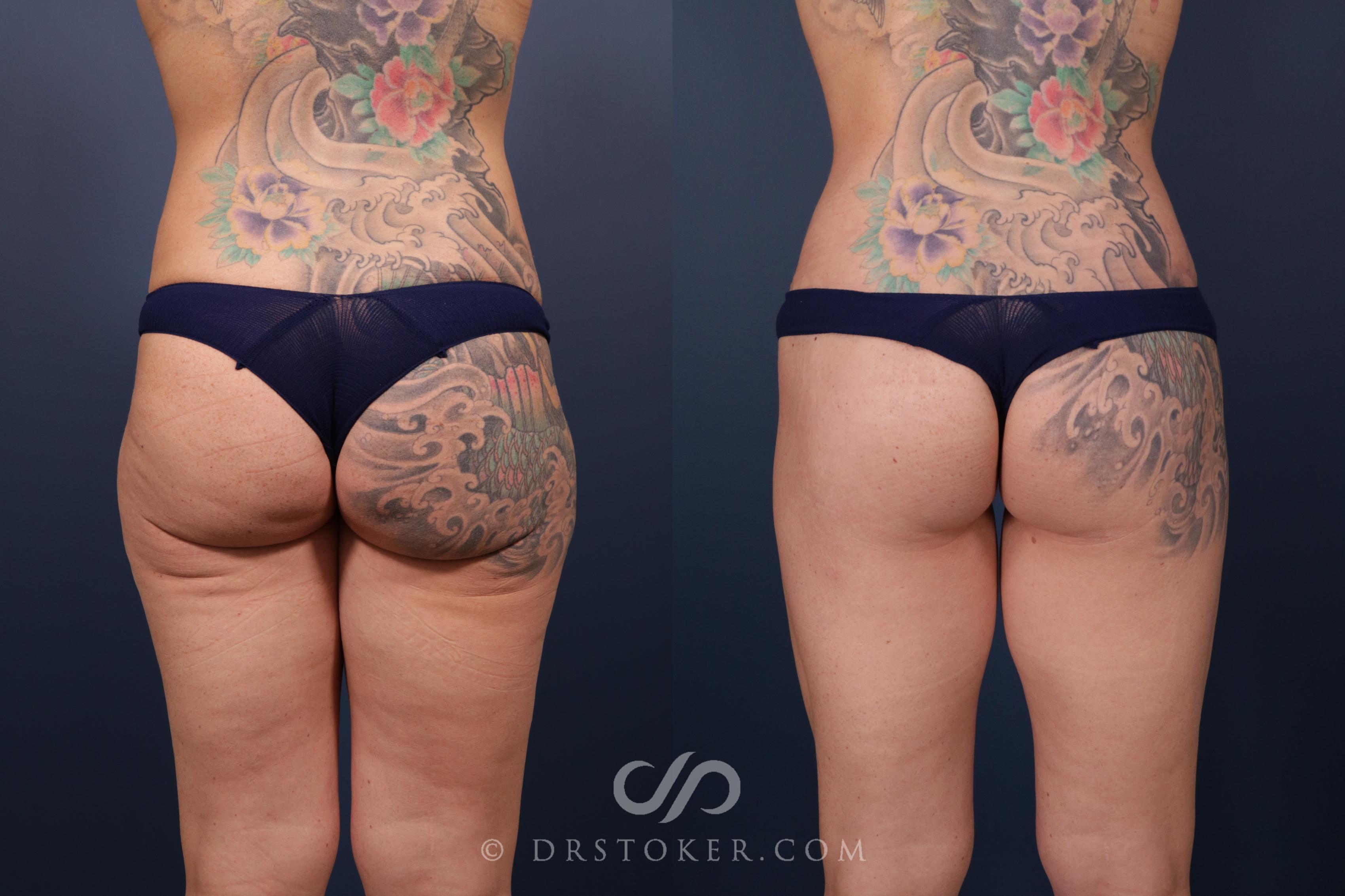 Before & After Bikini Body Lift ™ Case 2432 Back View in Los Angeles, CA