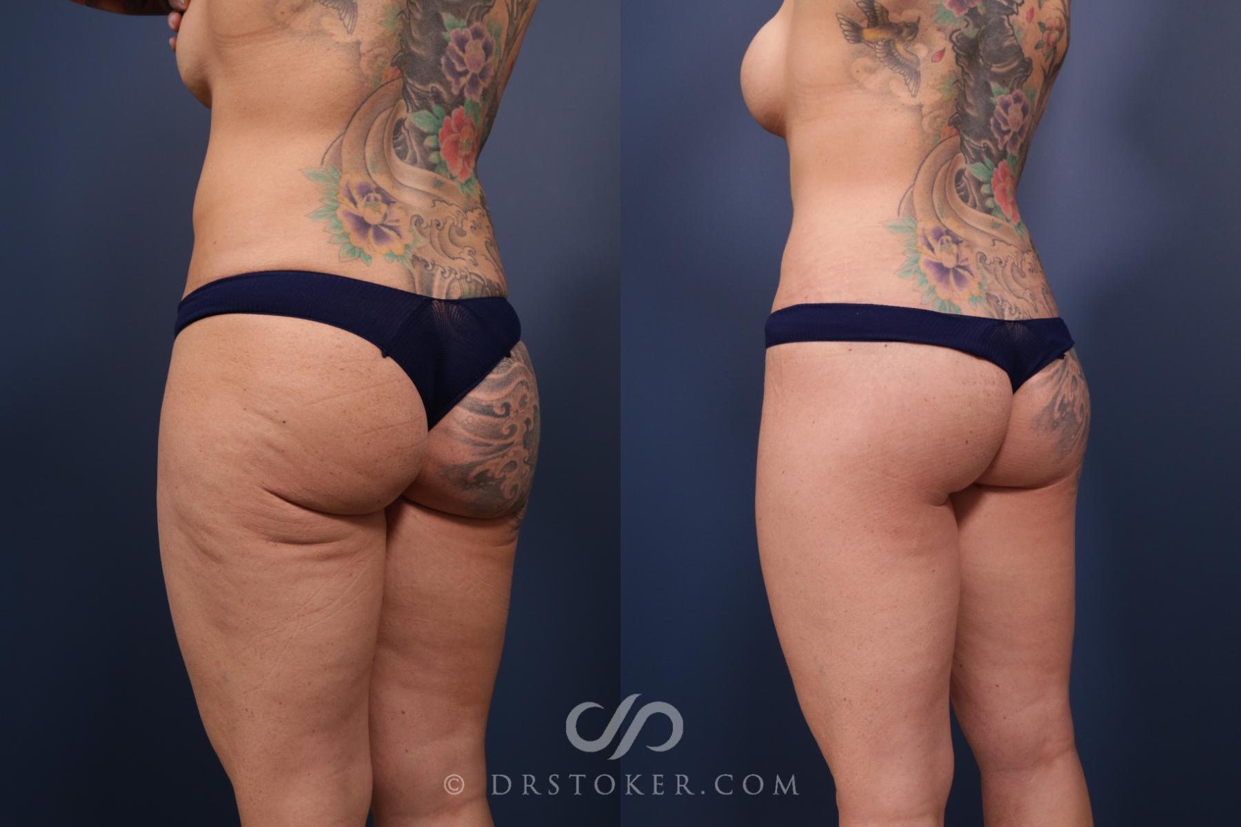 Before & After Bikini Body Lift ™ Case 2432 Left Oblique View in Los Angeles, CA