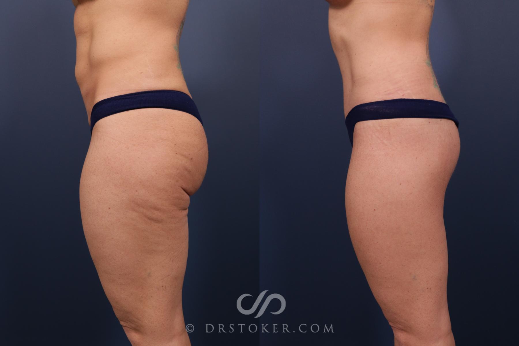 Before & After Bikini Body Lift ™ Case 2432 Left Side View in Los Angeles, CA