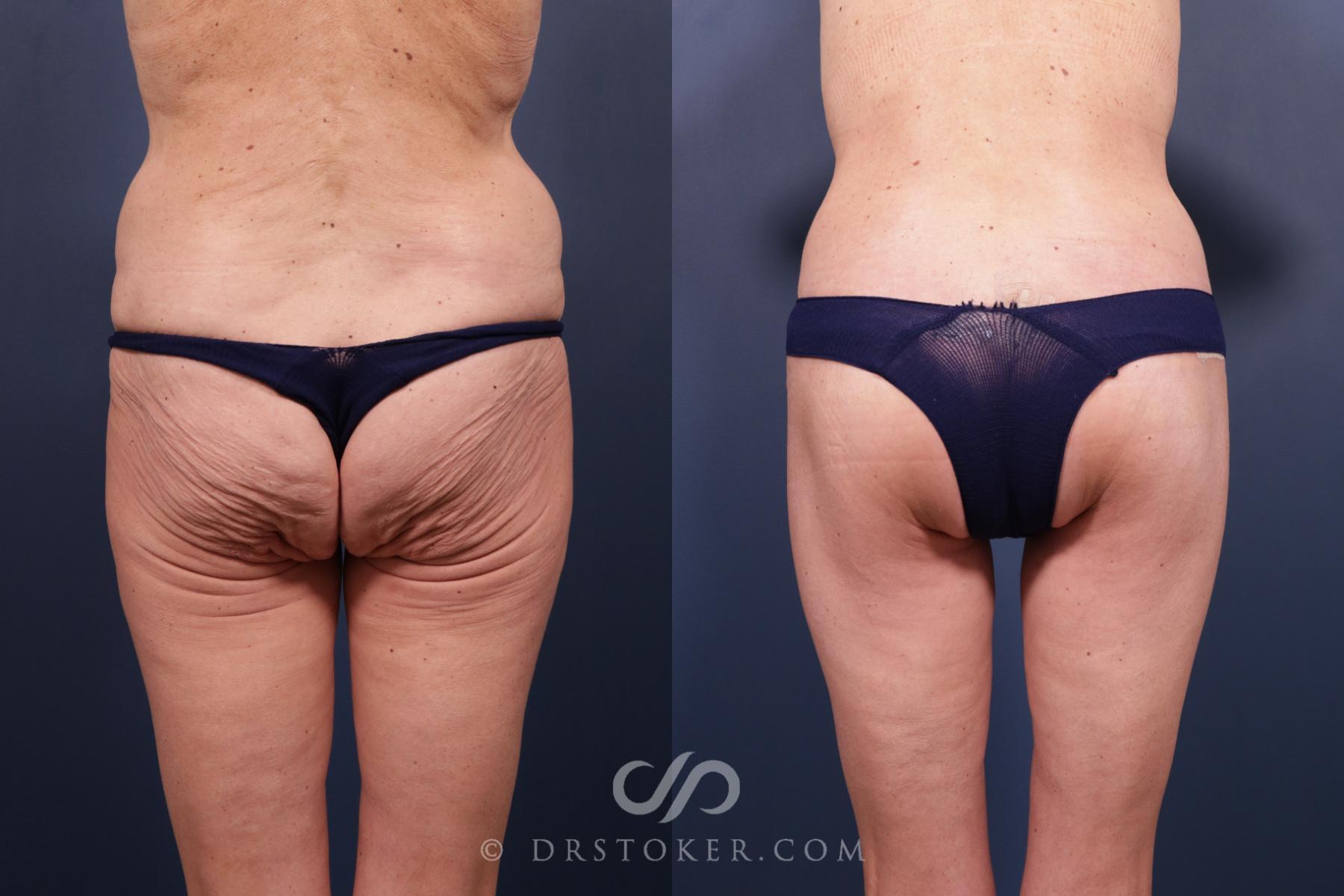 Before & After Bikini Body Lift ™ Case 2433 Back View in Los Angeles, CA