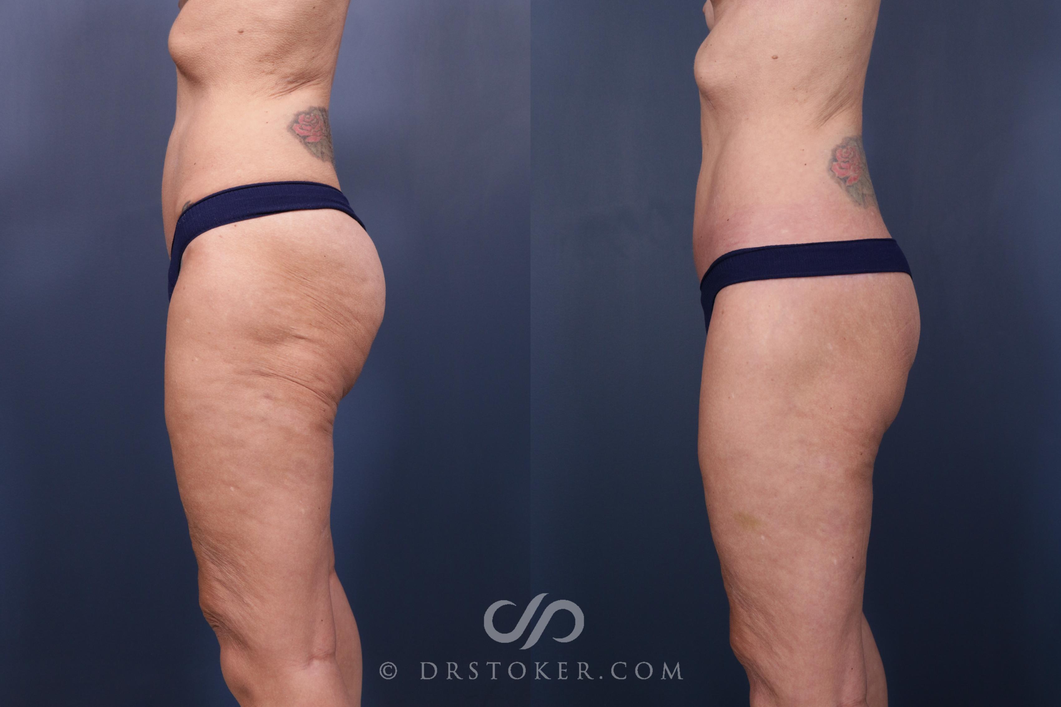 Before & After Bikini Body Lift ™ Case 2434 Left View in Los Angeles, CA