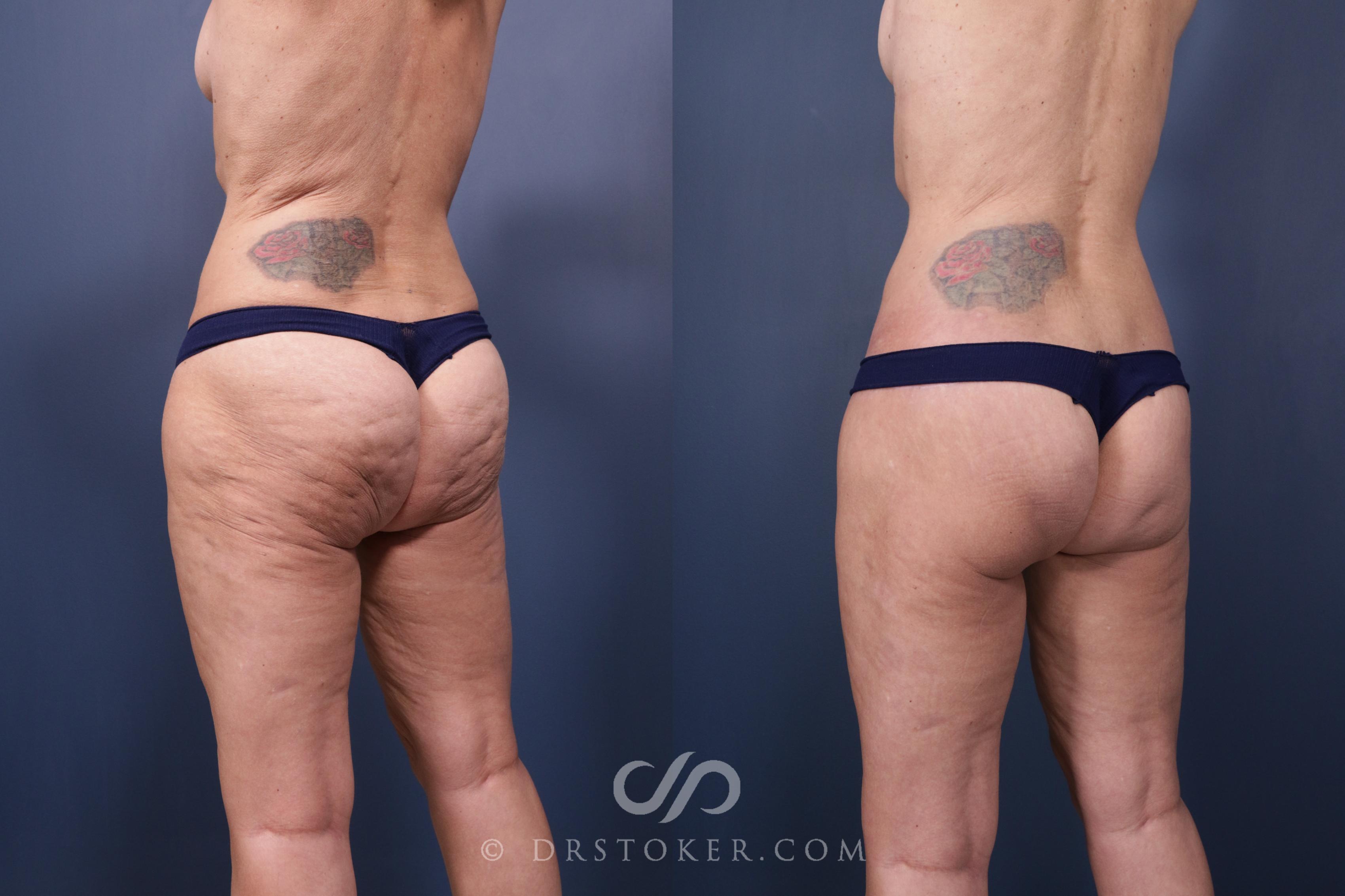 Before & After Bikini Body Lift ™ Case 2434 Left Oblique View in Los Angeles, CA