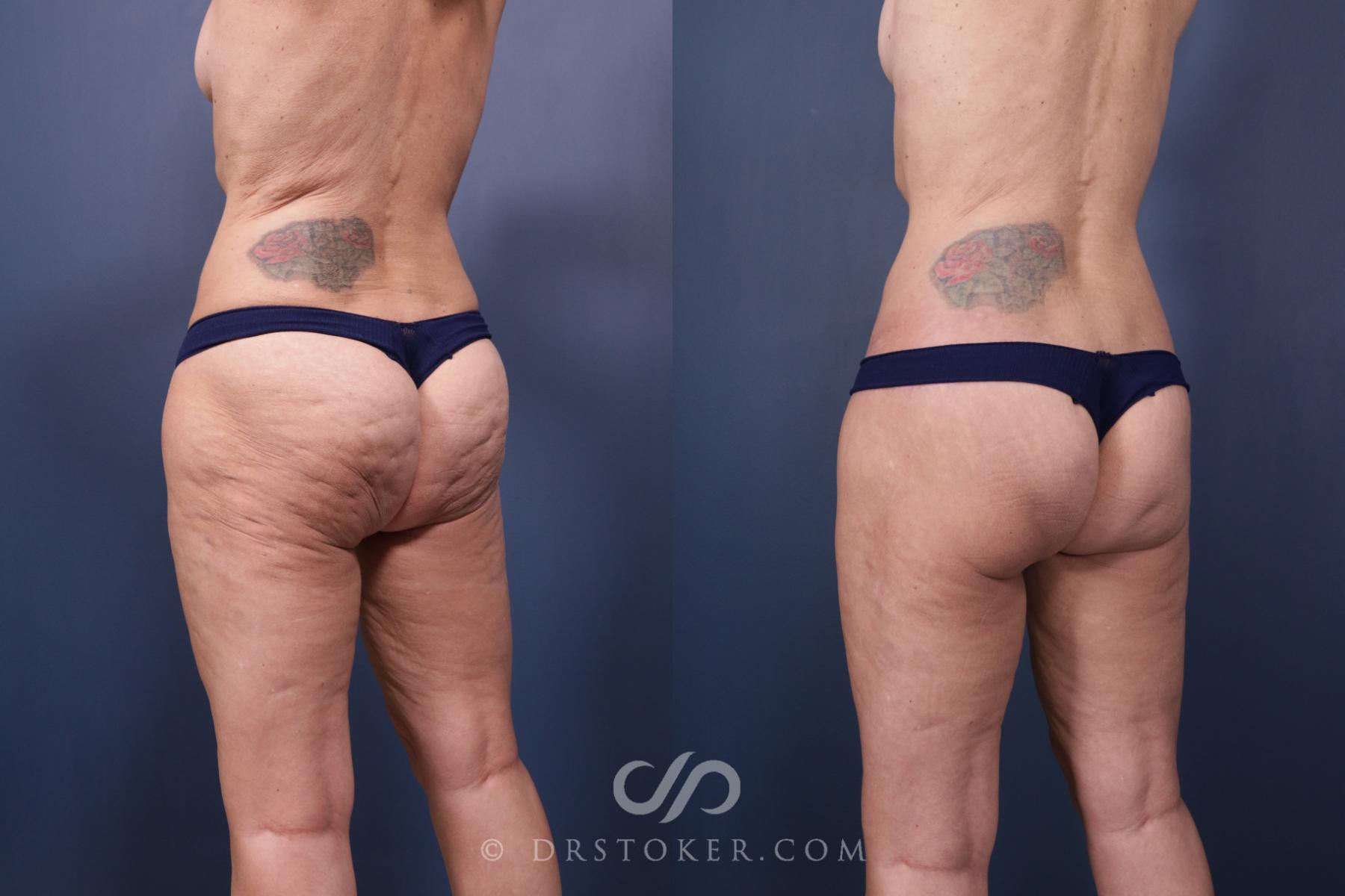 Before & After Bikini Body Lift ™ Case 2434 Left Oblique View in Los Angeles, CA
