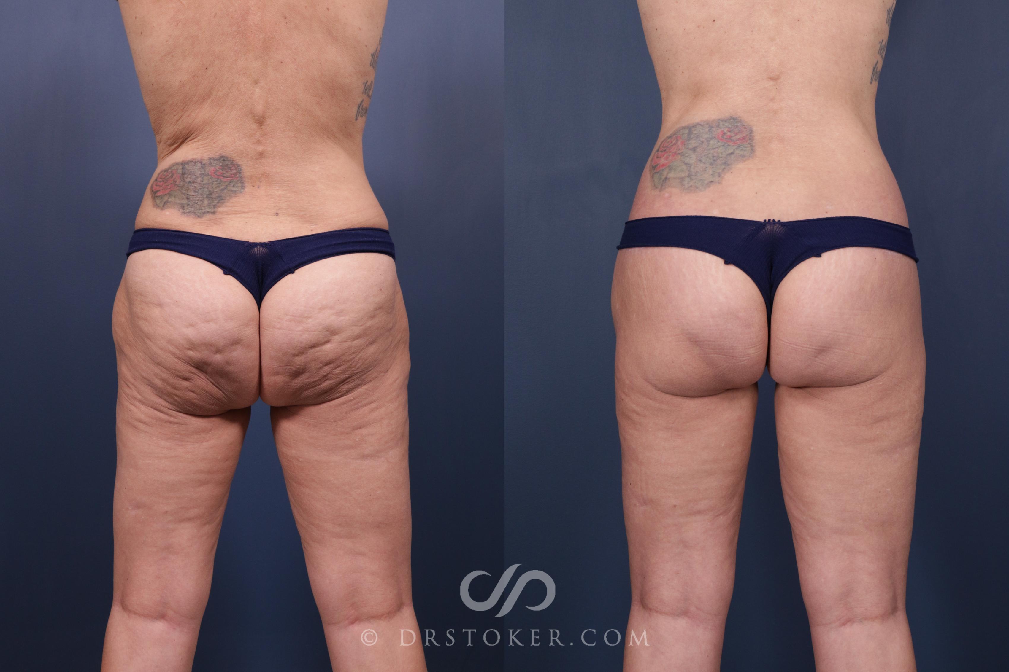 Before & After Bikini Body Lift ™ Case 2434 Left Side View in Los Angeles, CA