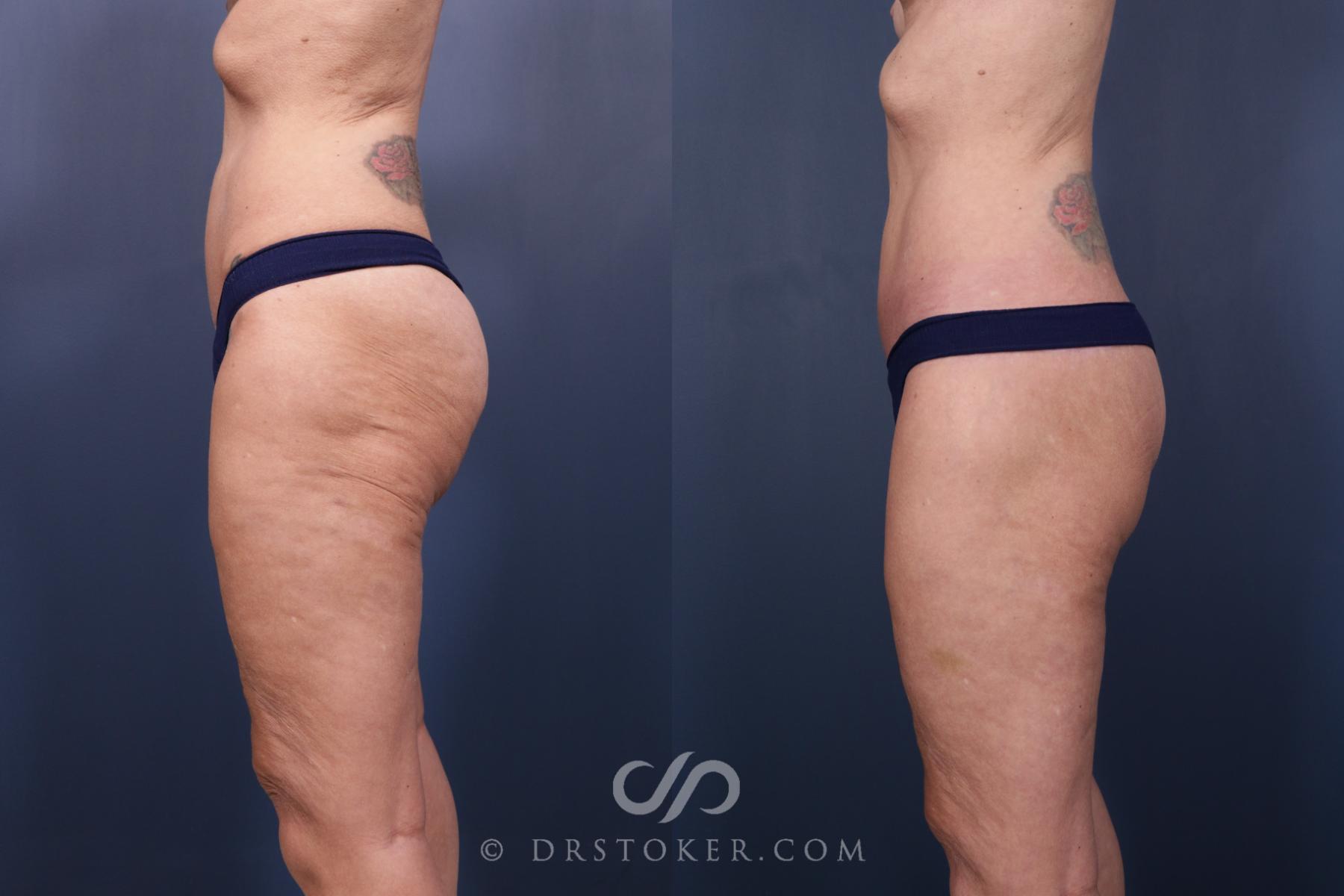 Before & After Bikini Body Lift ™ Case 2434 Left View in Los Angeles, CA