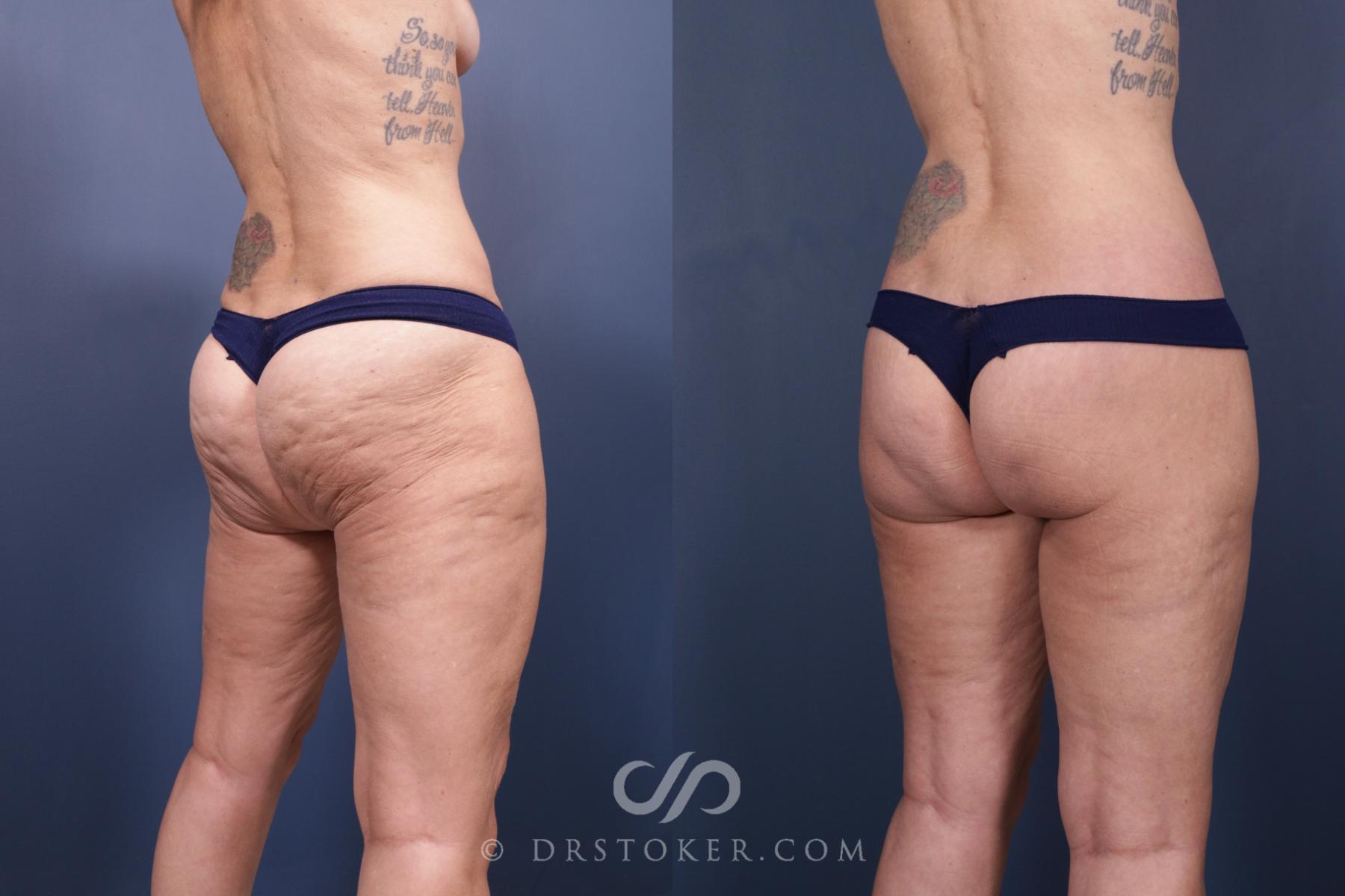 Before & After Bikini Body Lift ™ Case 2434 Right Oblique View in Los Angeles, CA
