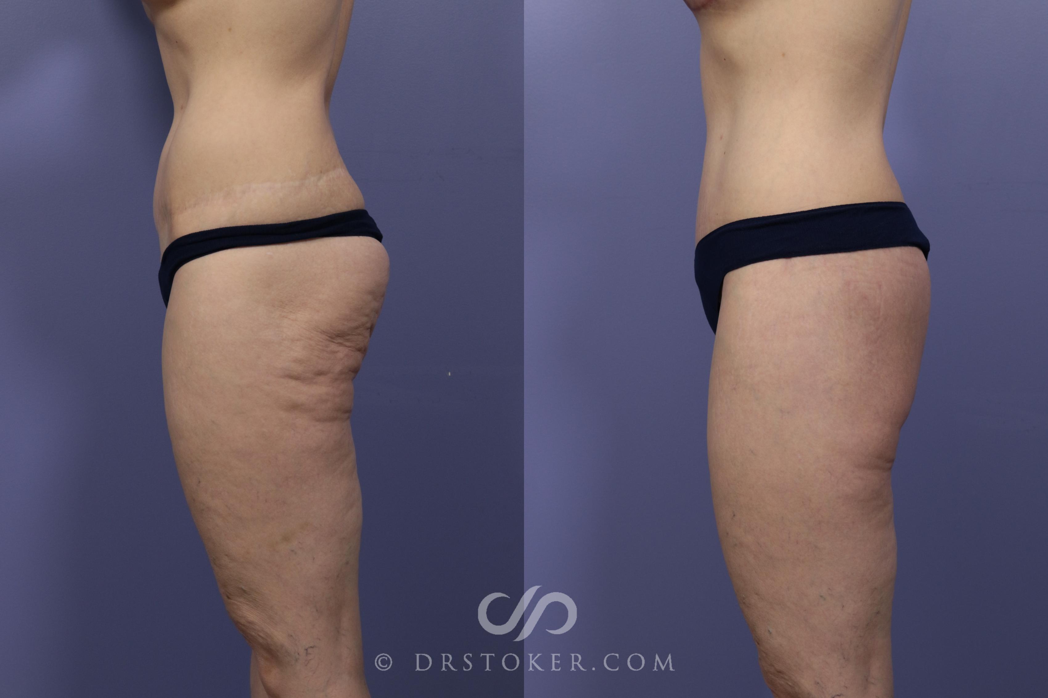 Before & After Bikini Body Lift ™ Case 2435 Left Side View in Los Angeles, CA
