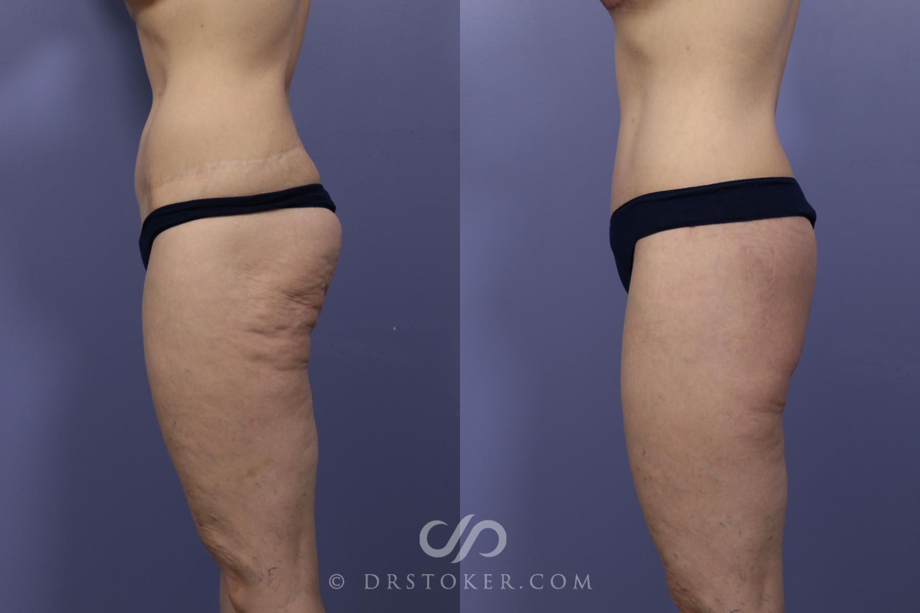Before & After Bikini Body Lift ™ Case 2435 Left Side View in Los Angeles, CA