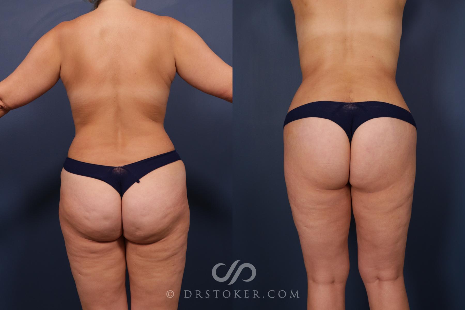 Before & After Bikini Body Lift ™ Case 2436 Back View in Los Angeles, CA