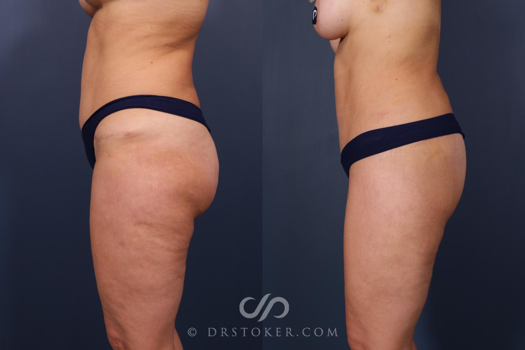 Before & After Bikini Body Lift ™ Case 2436 Left Side View in Los Angeles, CA