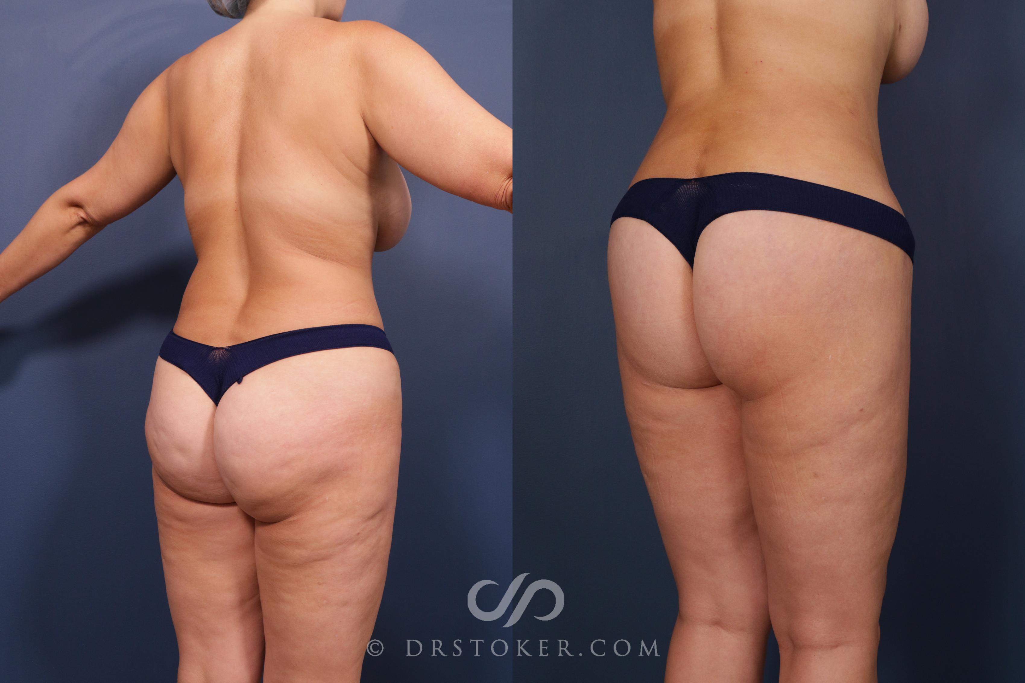 Before & After Bikini Body Lift ™ Case 2436 Right Oblique View in Los Angeles, CA