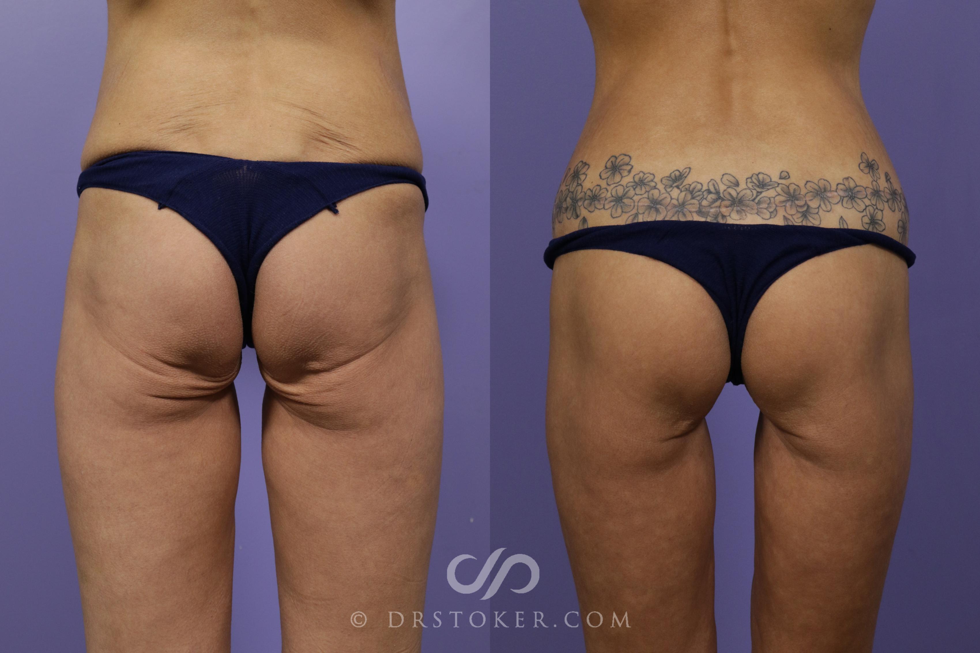 Before & After Bikini Body Lift ™ Case 2437 Back View in Los Angeles, CA