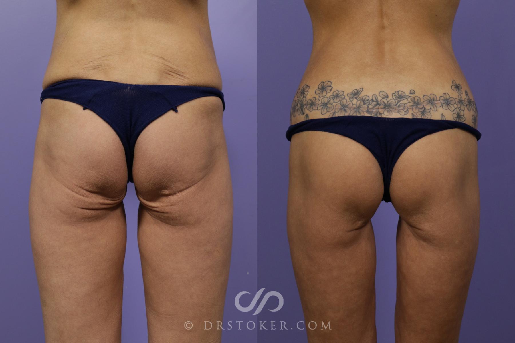 Before & After Bikini Body Lift ™ Case 2437 Back View in Los Angeles, CA