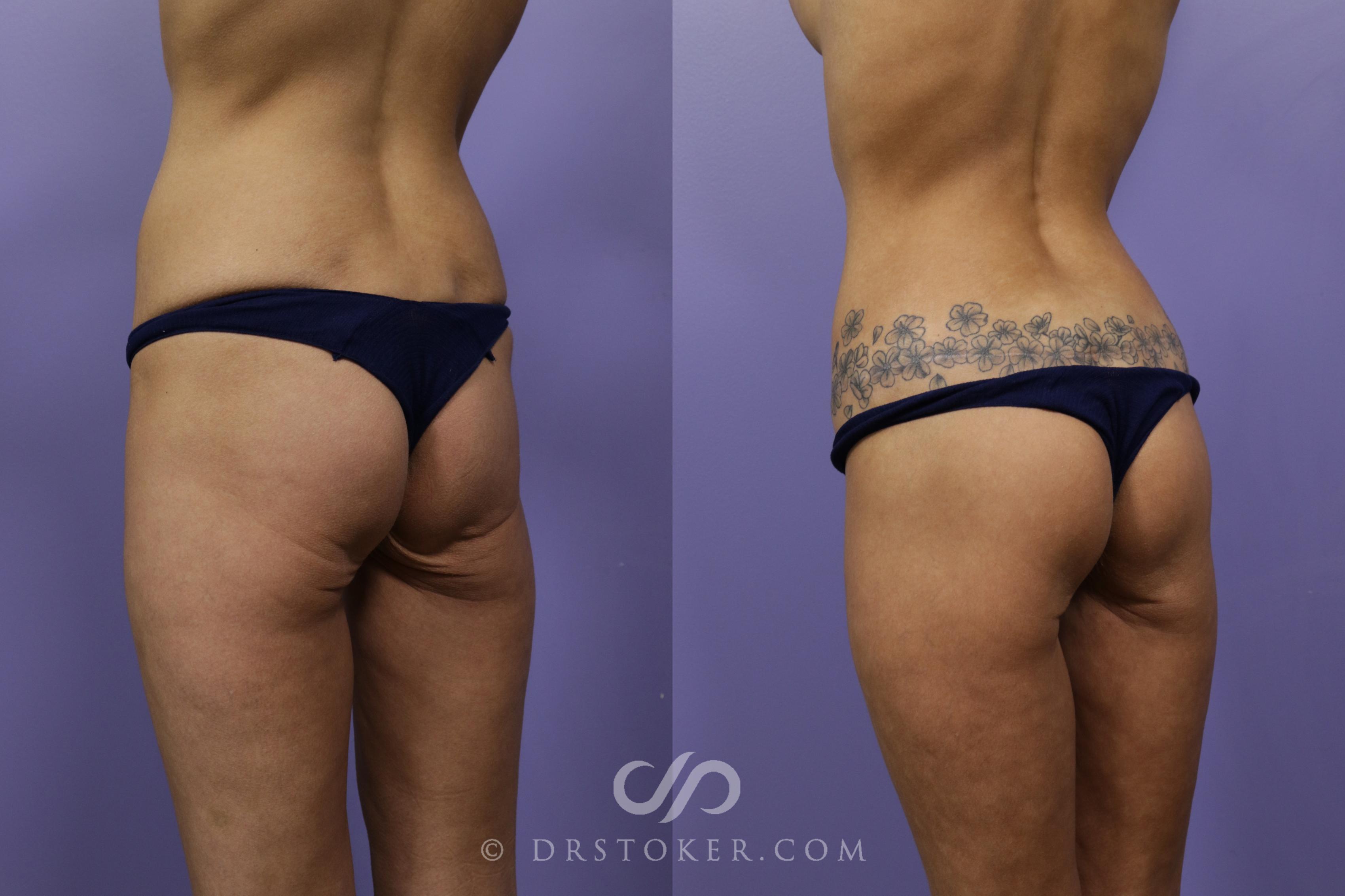 Before & After Bikini Body Lift ™ Case 2437 Left Oblique View in Los Angeles, CA