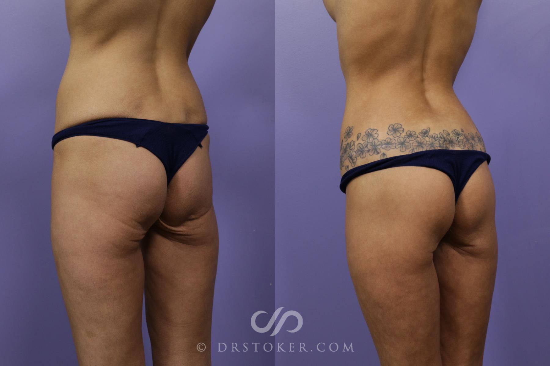 Before & After Bikini Body Lift ™ Case 2437 Left Oblique View in Los Angeles, CA