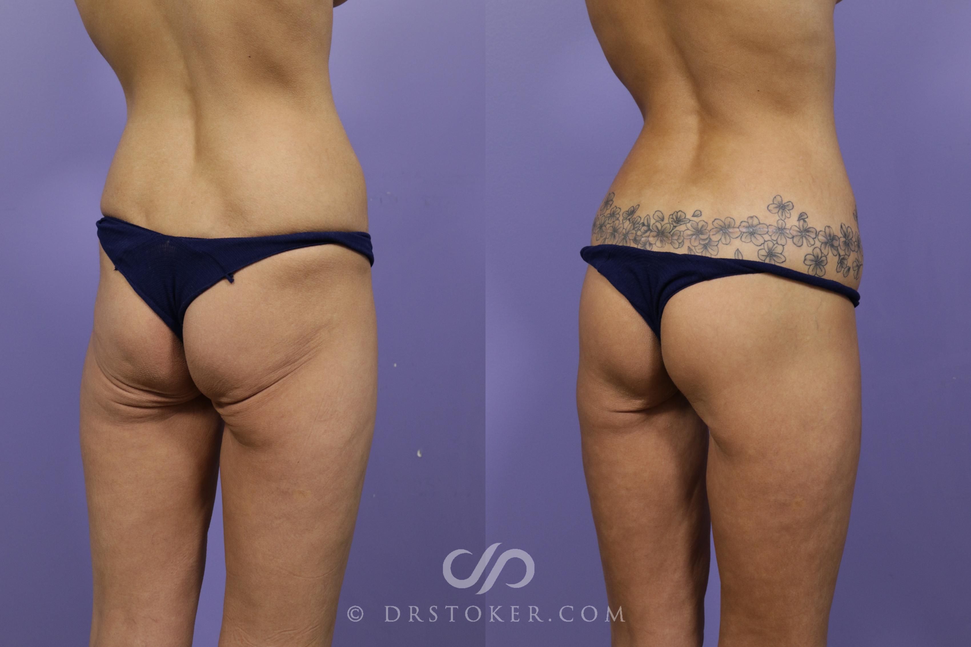 Before & After Bikini Body Lift ™ Case 2437 Right Oblique View in Los Angeles, CA