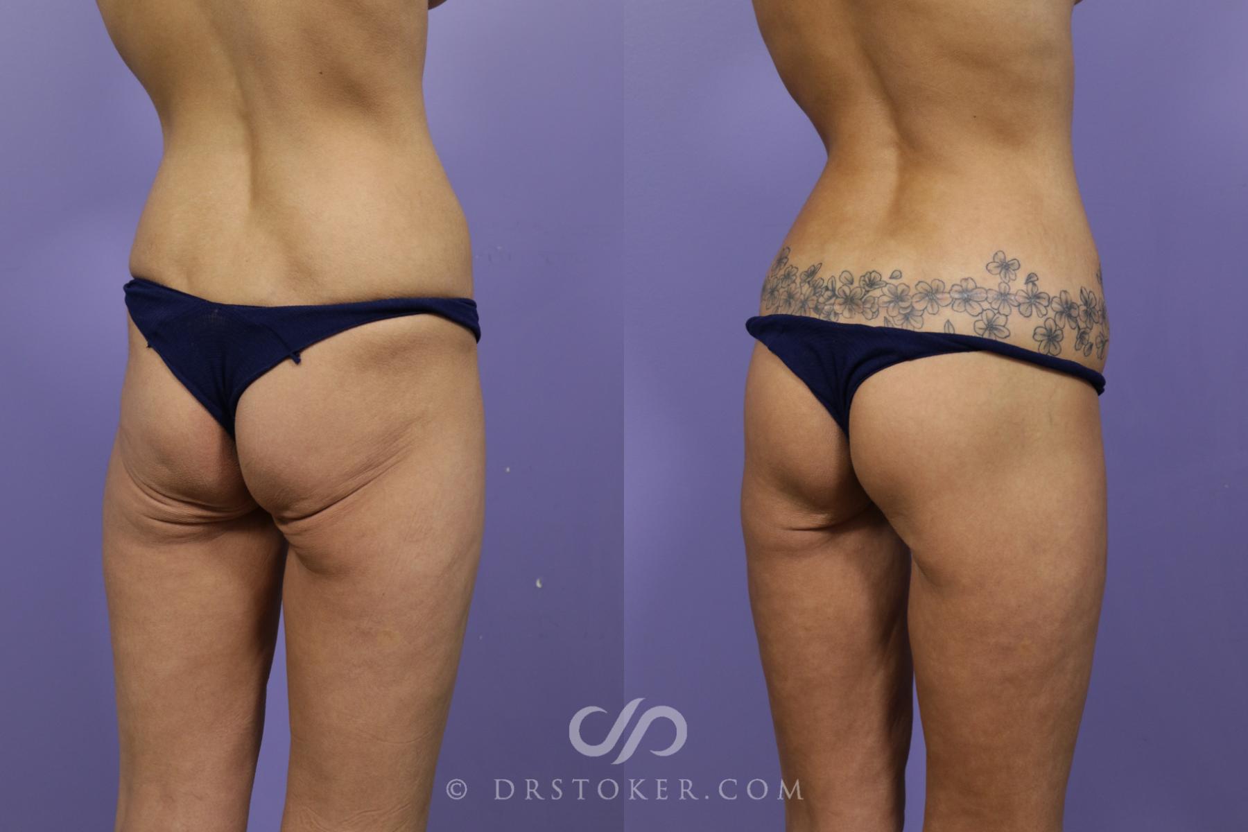 Before & After Bikini Body Lift ™ Case 2437 Right Oblique View in Los Angeles, CA