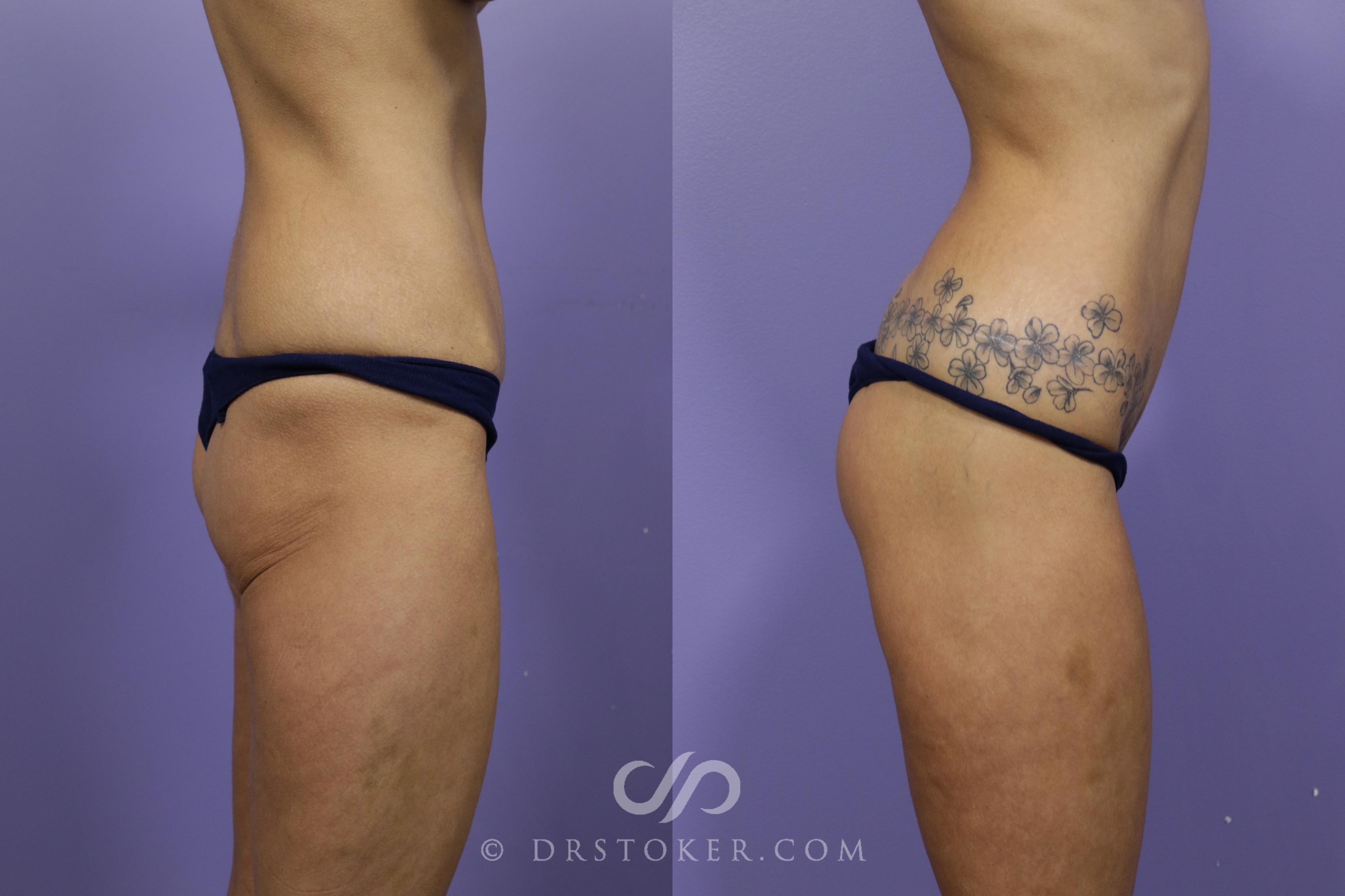 Before & After Bikini Body Lift ™ Case 2437 Right Side View in Los Angeles, CA
