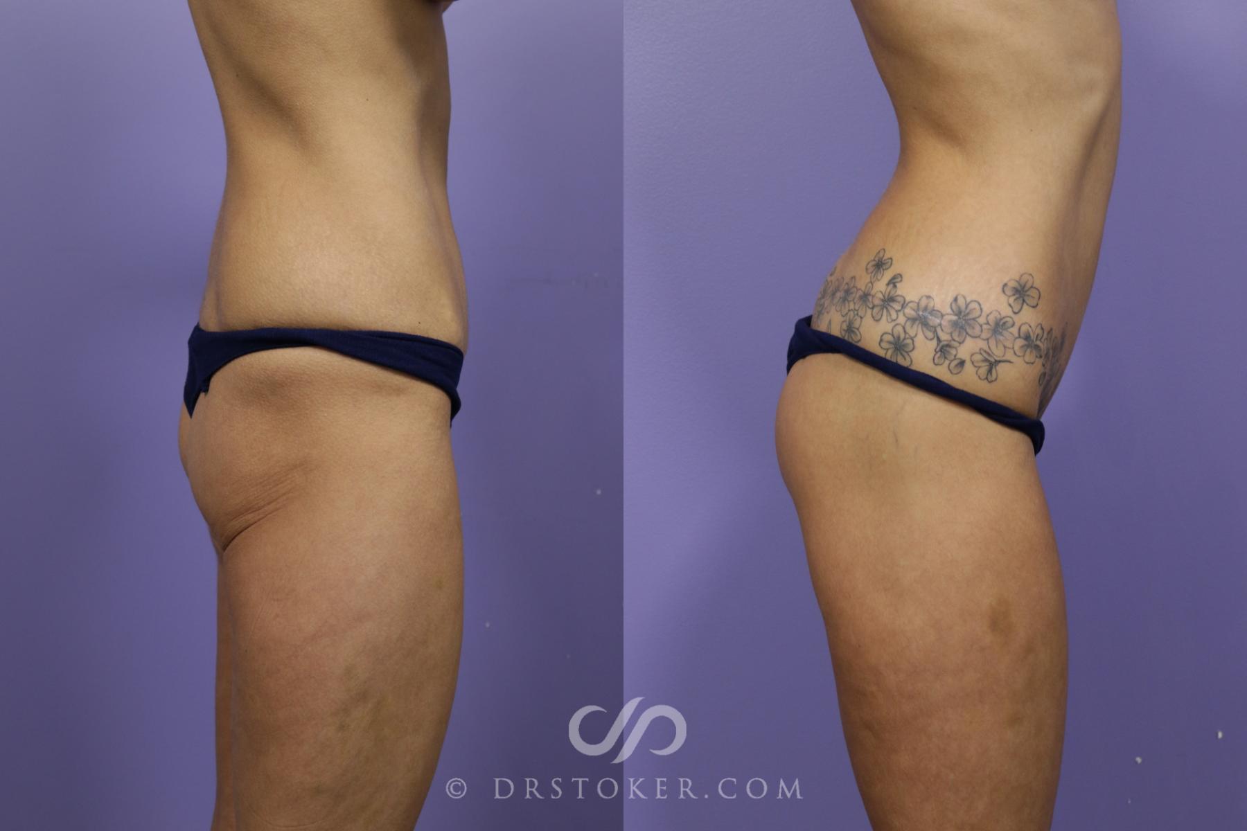 Before & After Bikini Body Lift ™ Case 2437 Right Side View in Los Angeles, CA