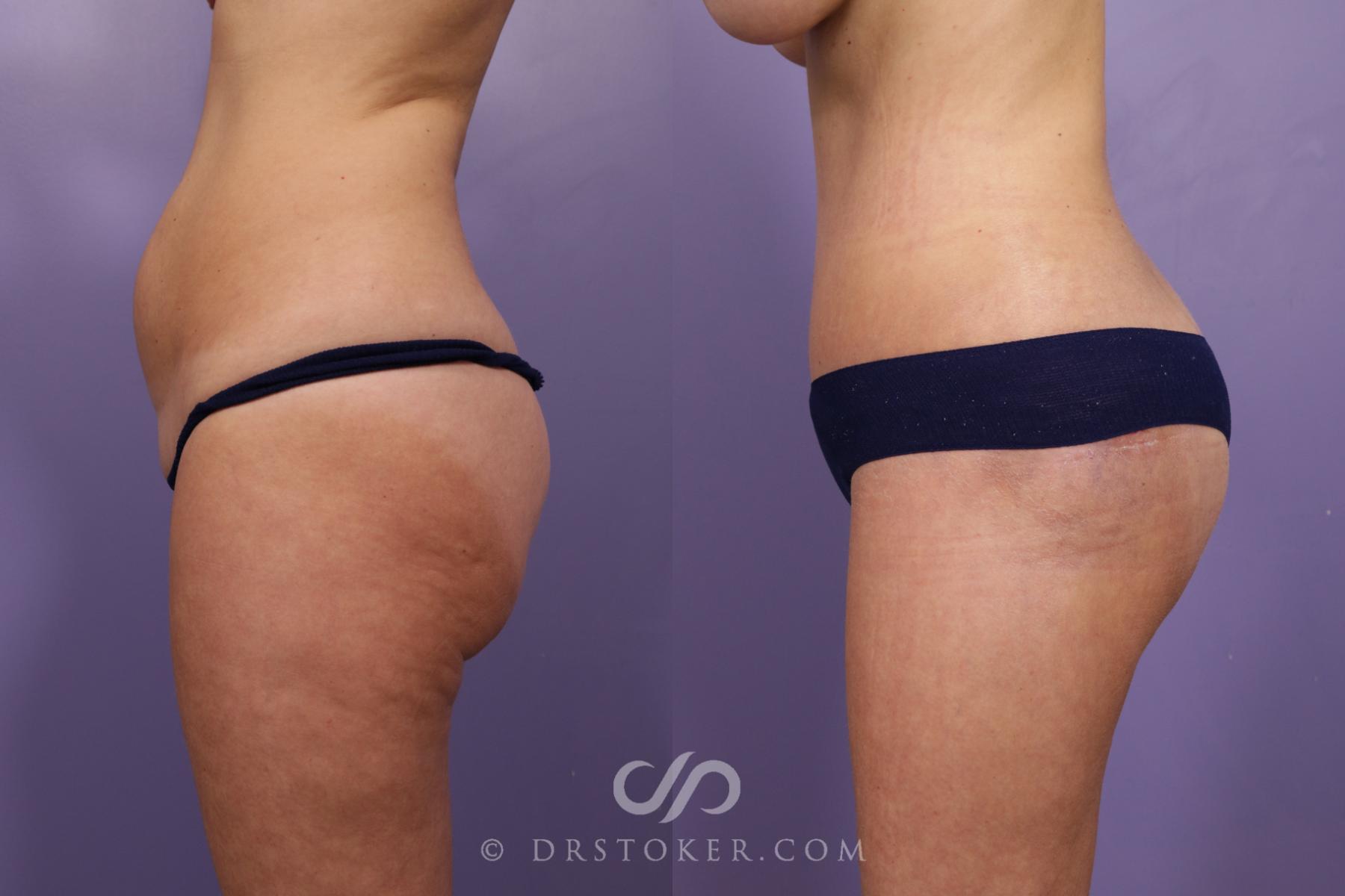 Before & After Bikini Body Lift ™ Case 2438 Left Side View in Los Angeles, CA