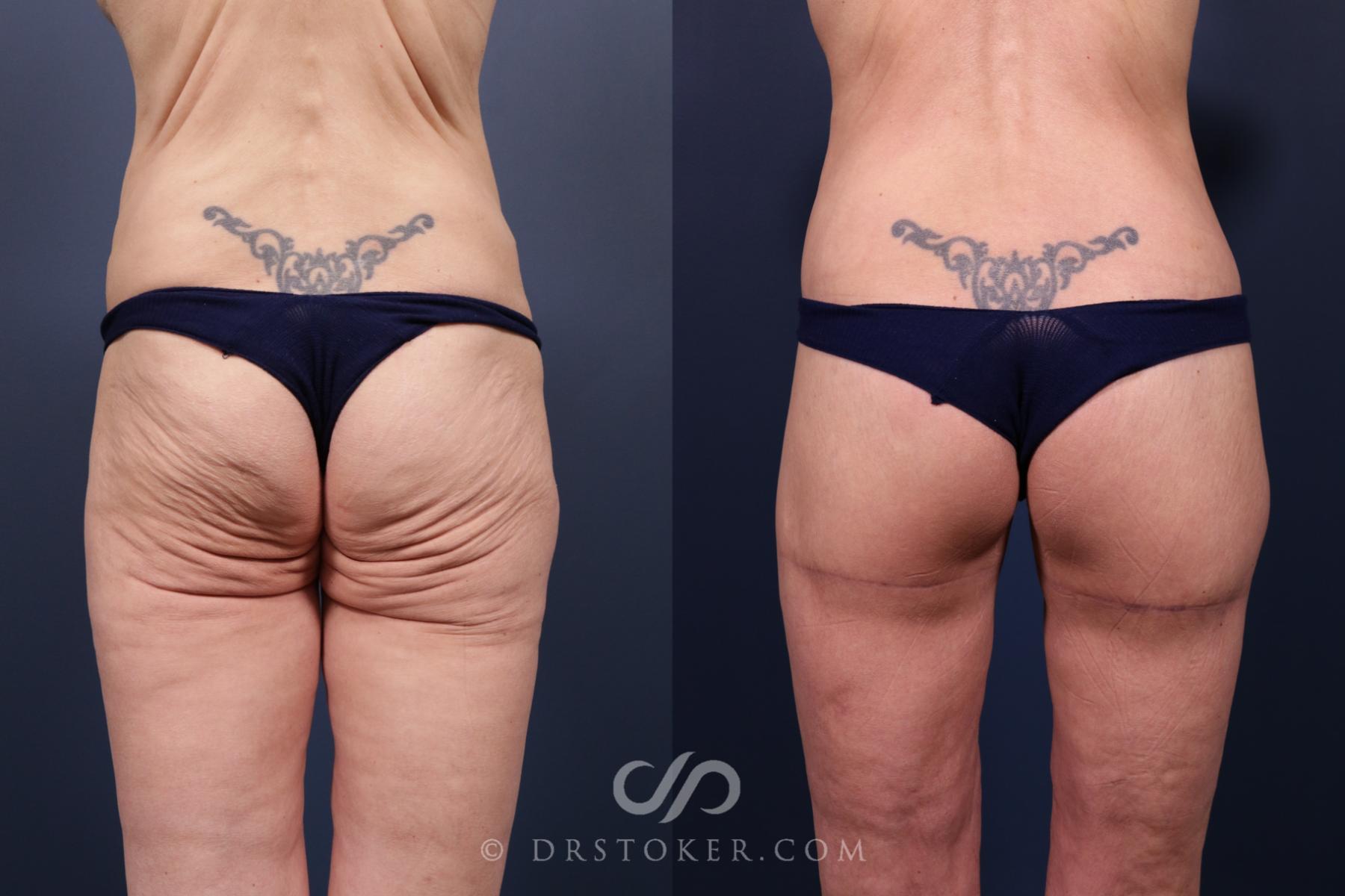 Before & After Bikini Body Lift ™ Case 2439 Back View in Los Angeles, CA