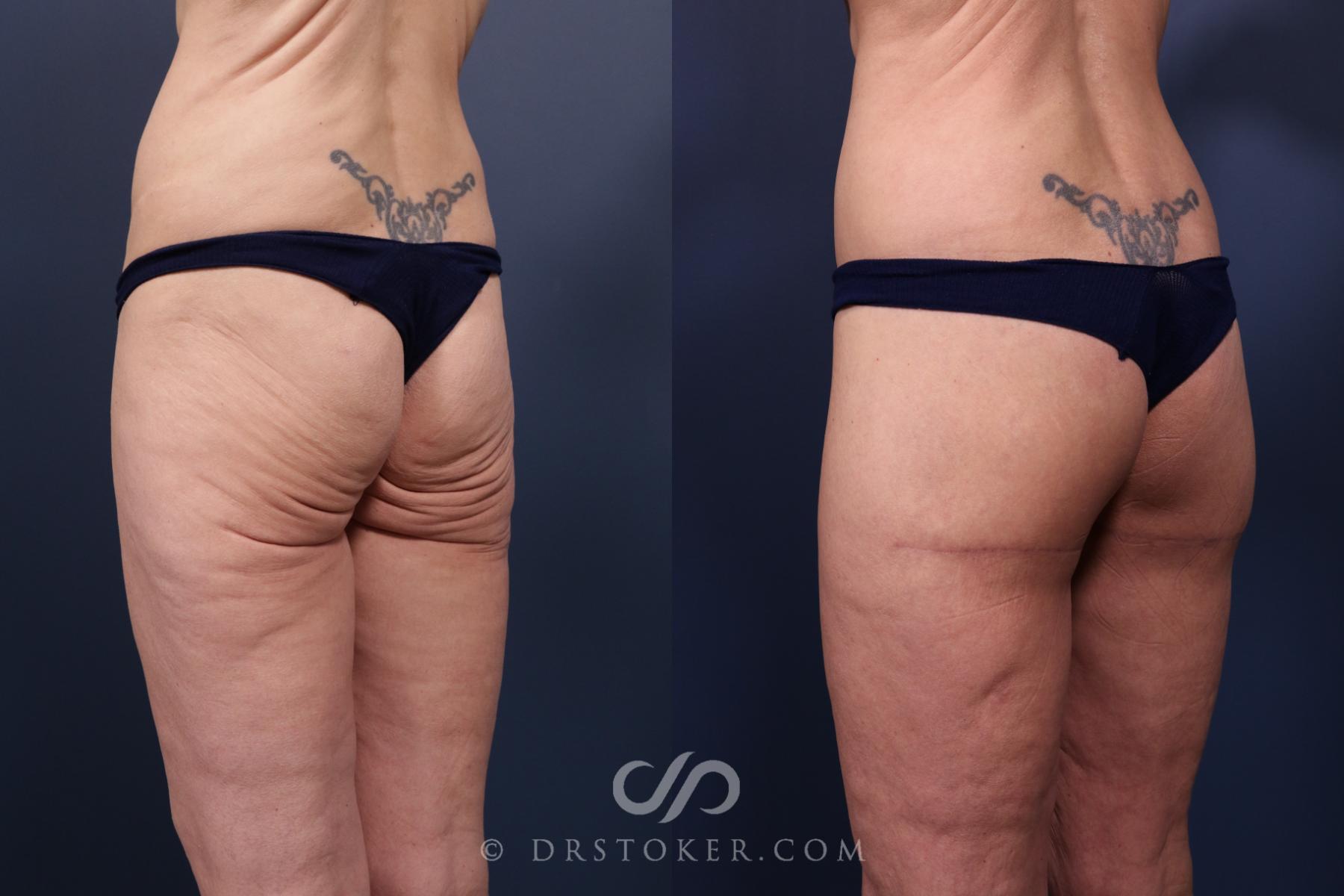 Before & After Bikini Body Lift ™ Case 2439 Left Oblique View in Los Angeles, CA