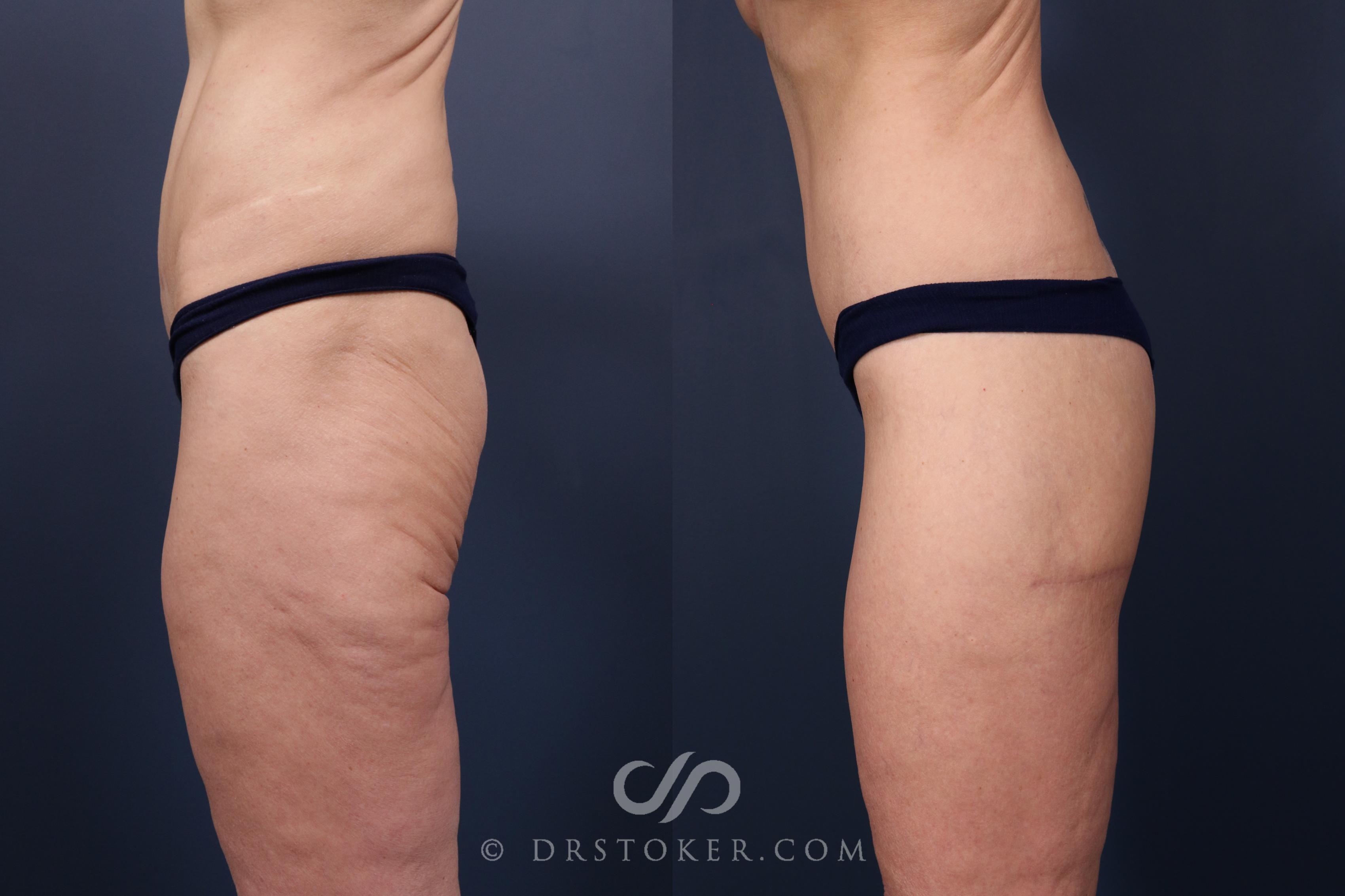 Before & After Bikini Body Lift ™ Case 2439 Left Side View in Los Angeles, CA