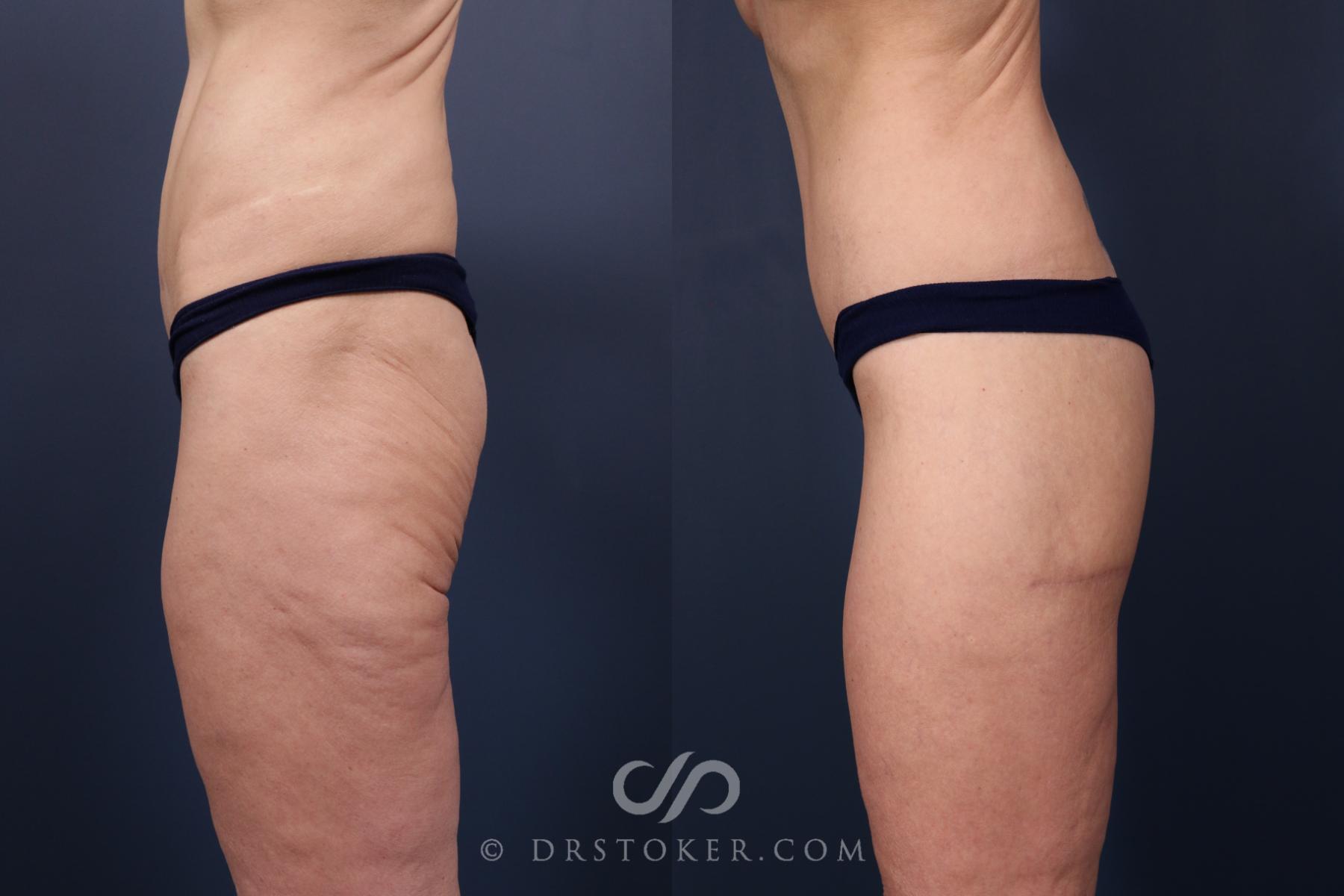 Before & After Bikini Body Lift ™ Case 2439 Left Side View in Los Angeles, CA