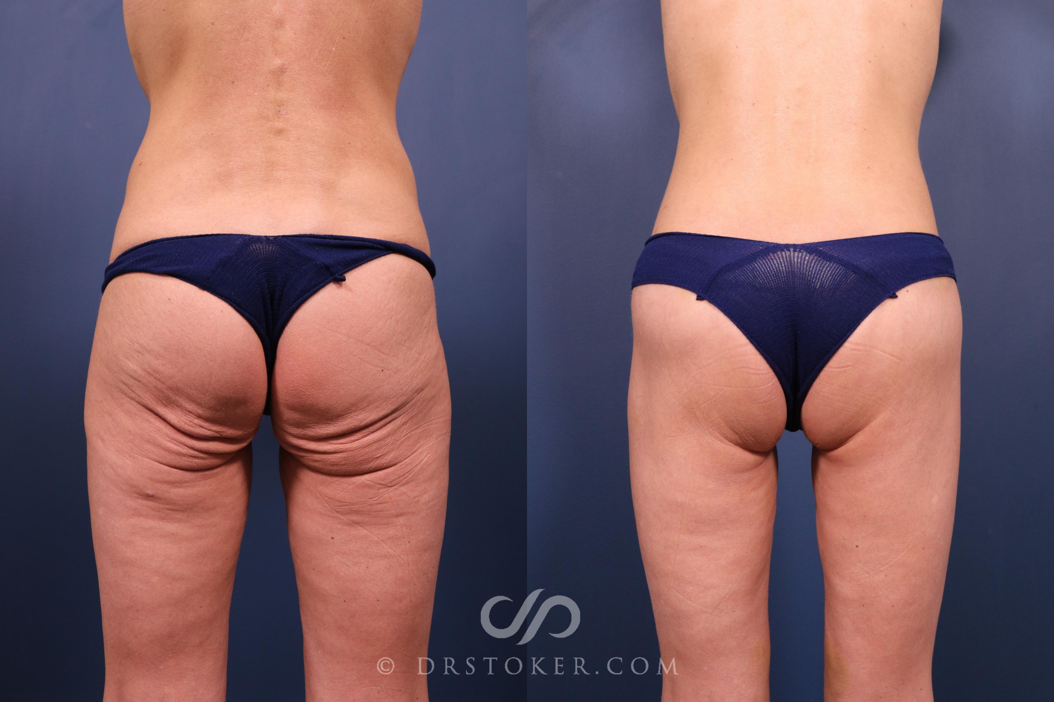 Before & After Bikini Body Lift ™ Case 2440 Back View in Los Angeles, CA