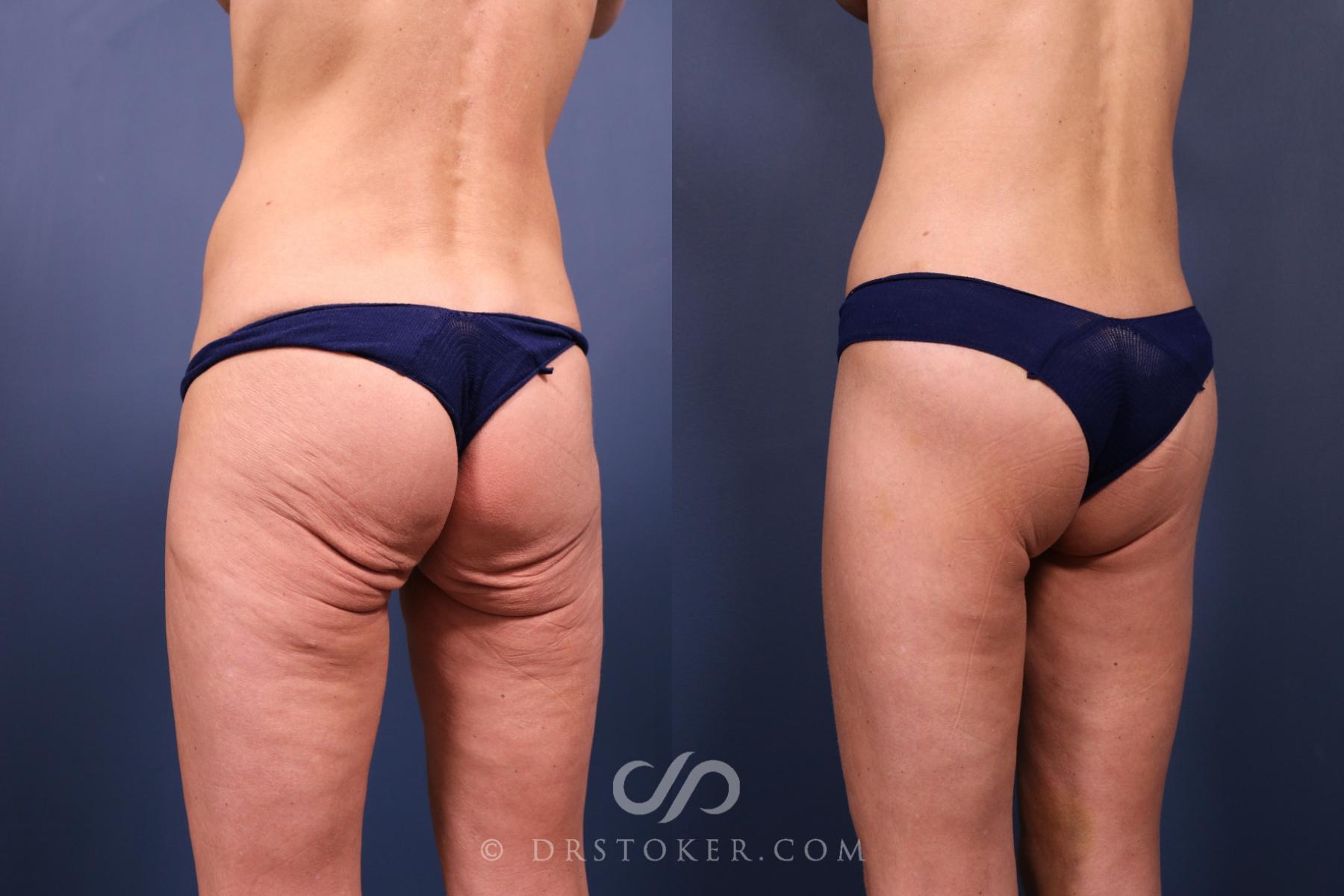 Before & After Bikini Body Lift ™ Case 2440 Left Oblique View in Los Angeles, CA