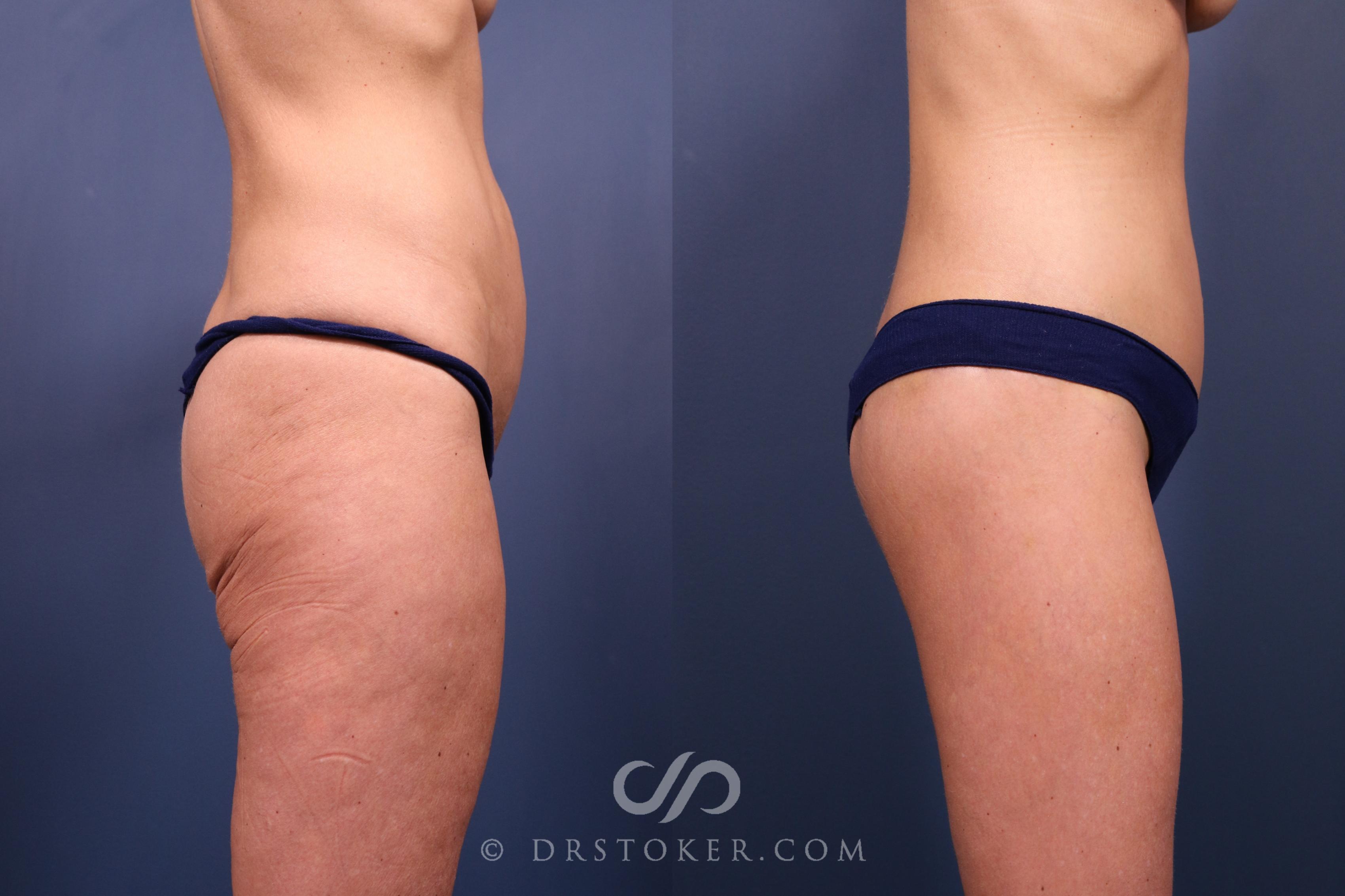 Before & After Bikini Body Lift ™ Case 2440 Right Side View in Los Angeles, CA